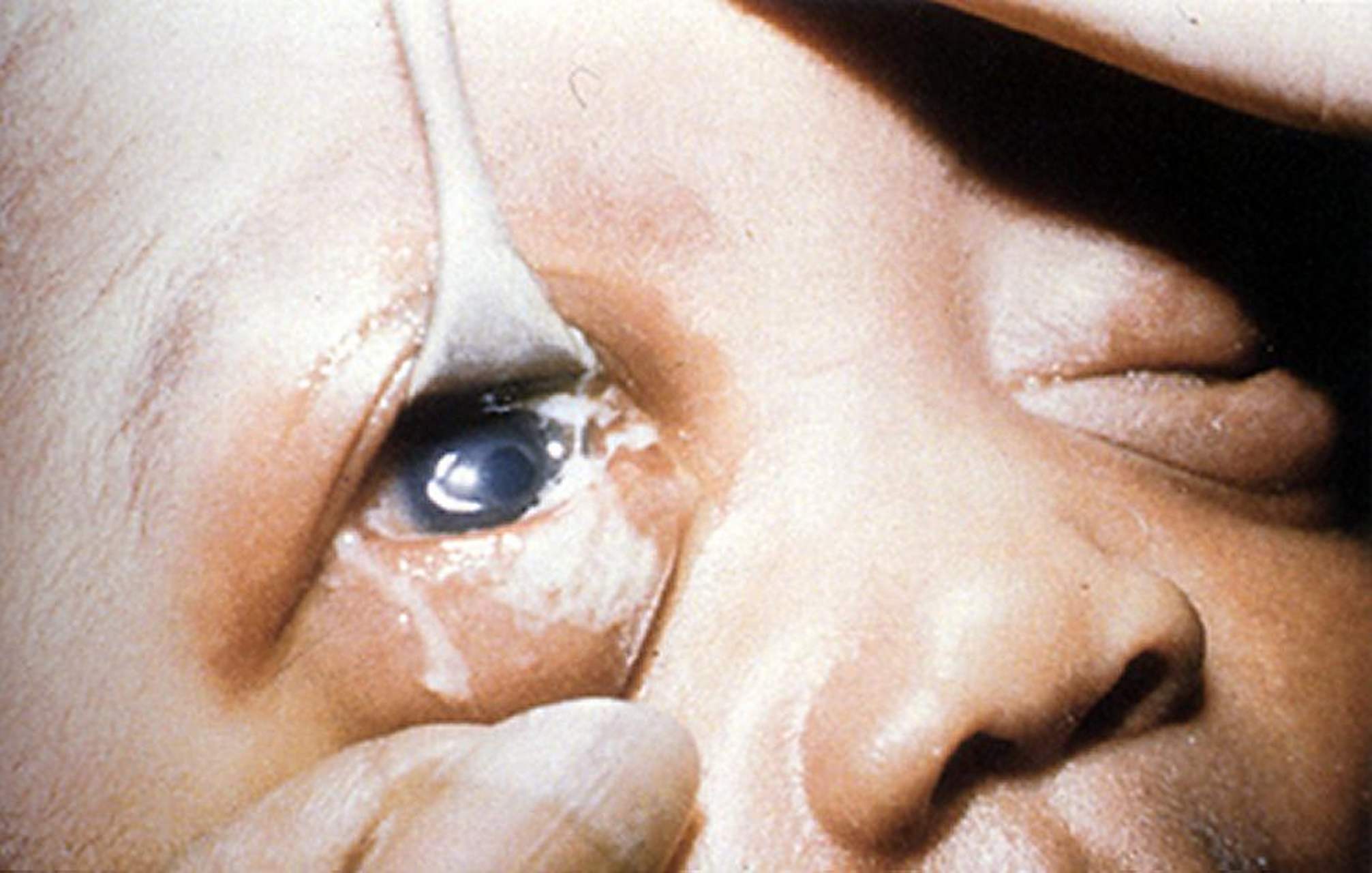 刚出生一周的男宝宝,眼睛被眼屎糊的睁不开眼,婆婆说火气太大了,非要