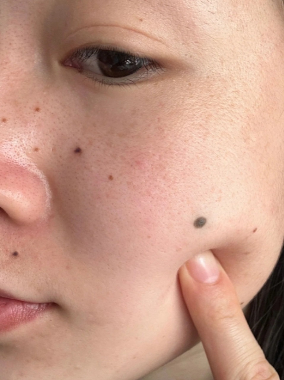 鱼鳞痣怎么去除?