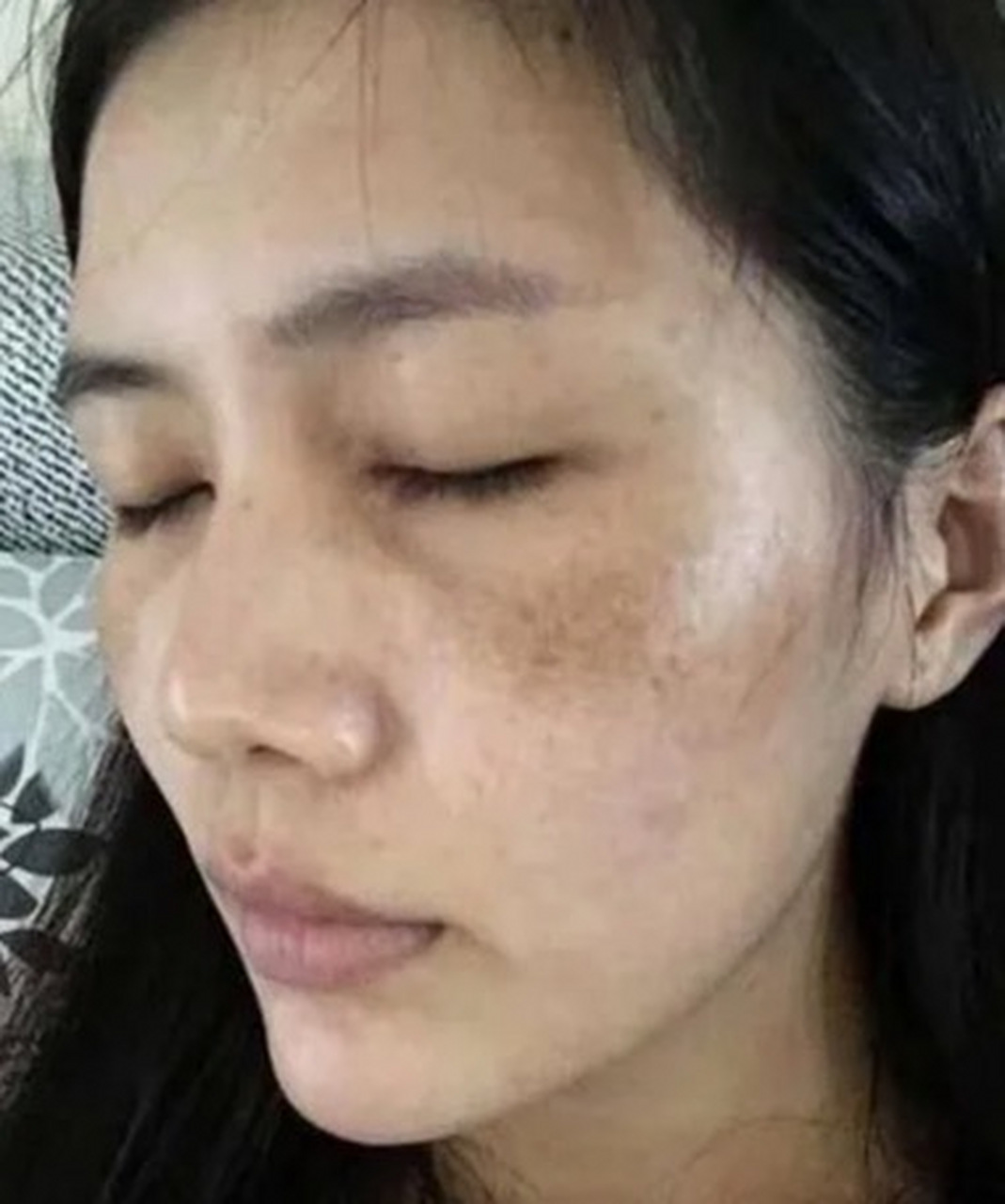怎么去脸上的黄褐斑最有效?