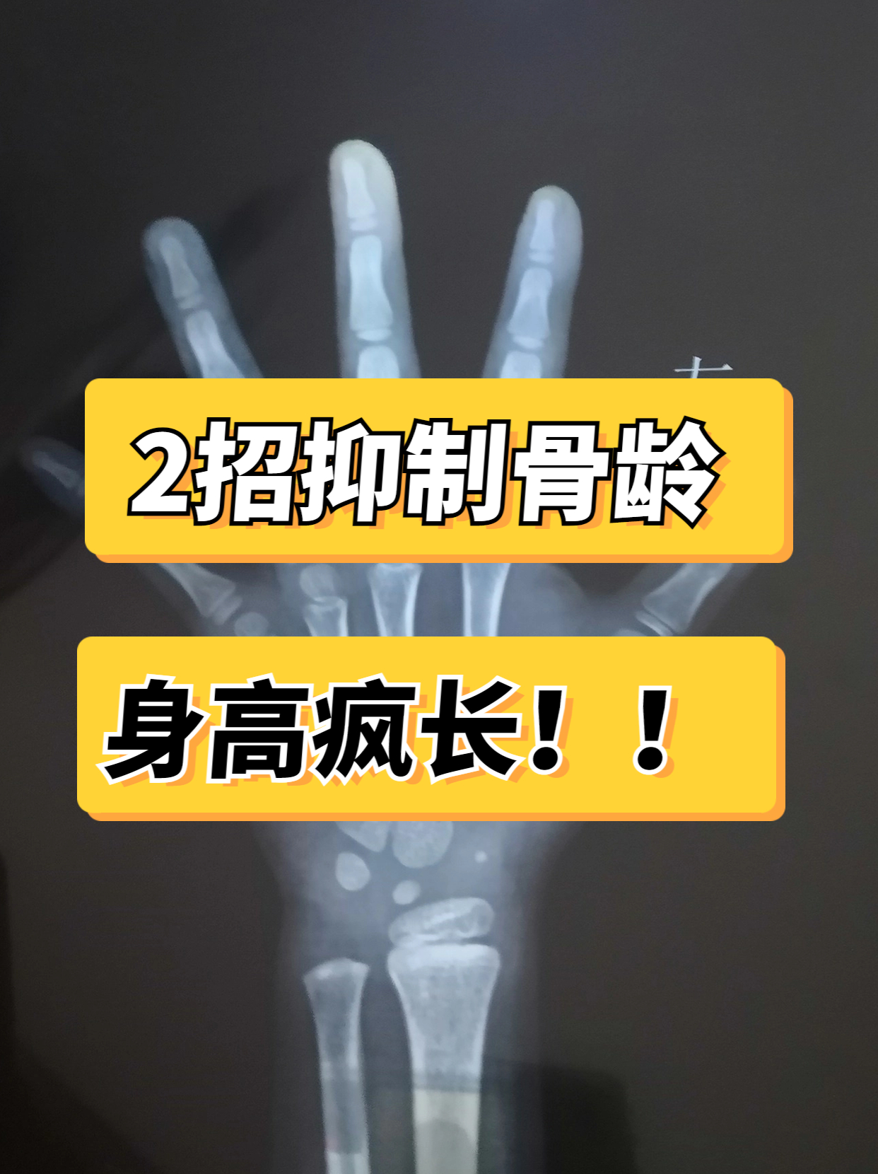 去年我接诊了一个9岁5个月的小女孩当时测骨龄已经11岁b超显示孩子