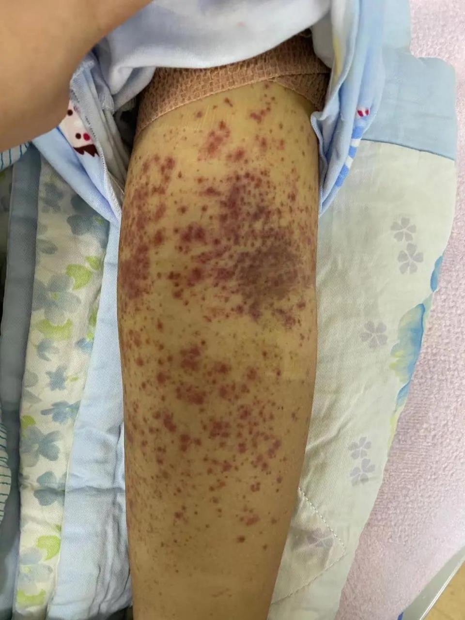 这位患者最近发现腿上莫名出现很多红点,经检查是血小板减少性紫癜.
