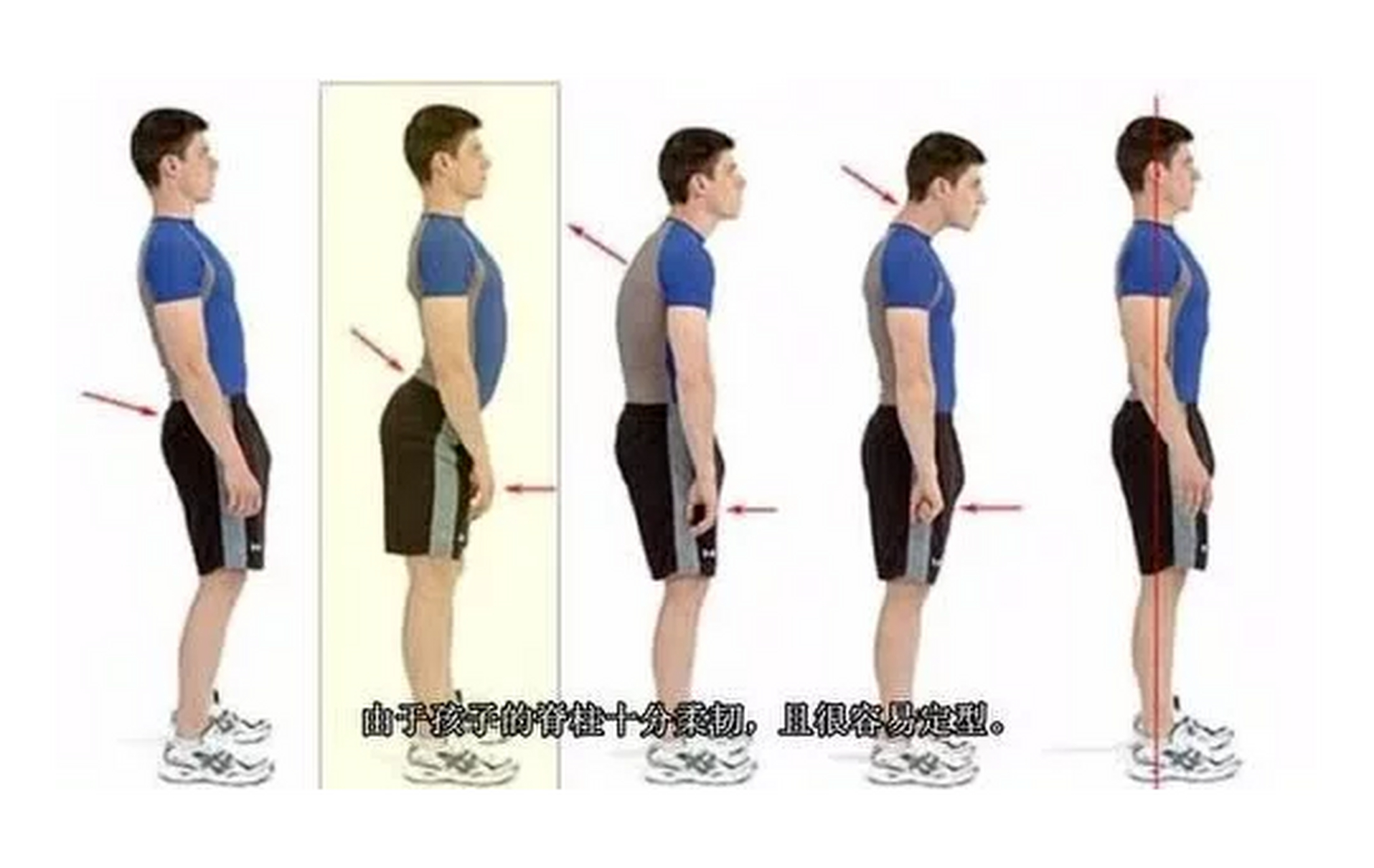 家长要重视孩子脊柱健康 脊柱侧弯在青少年人群中的发病率与日俱增