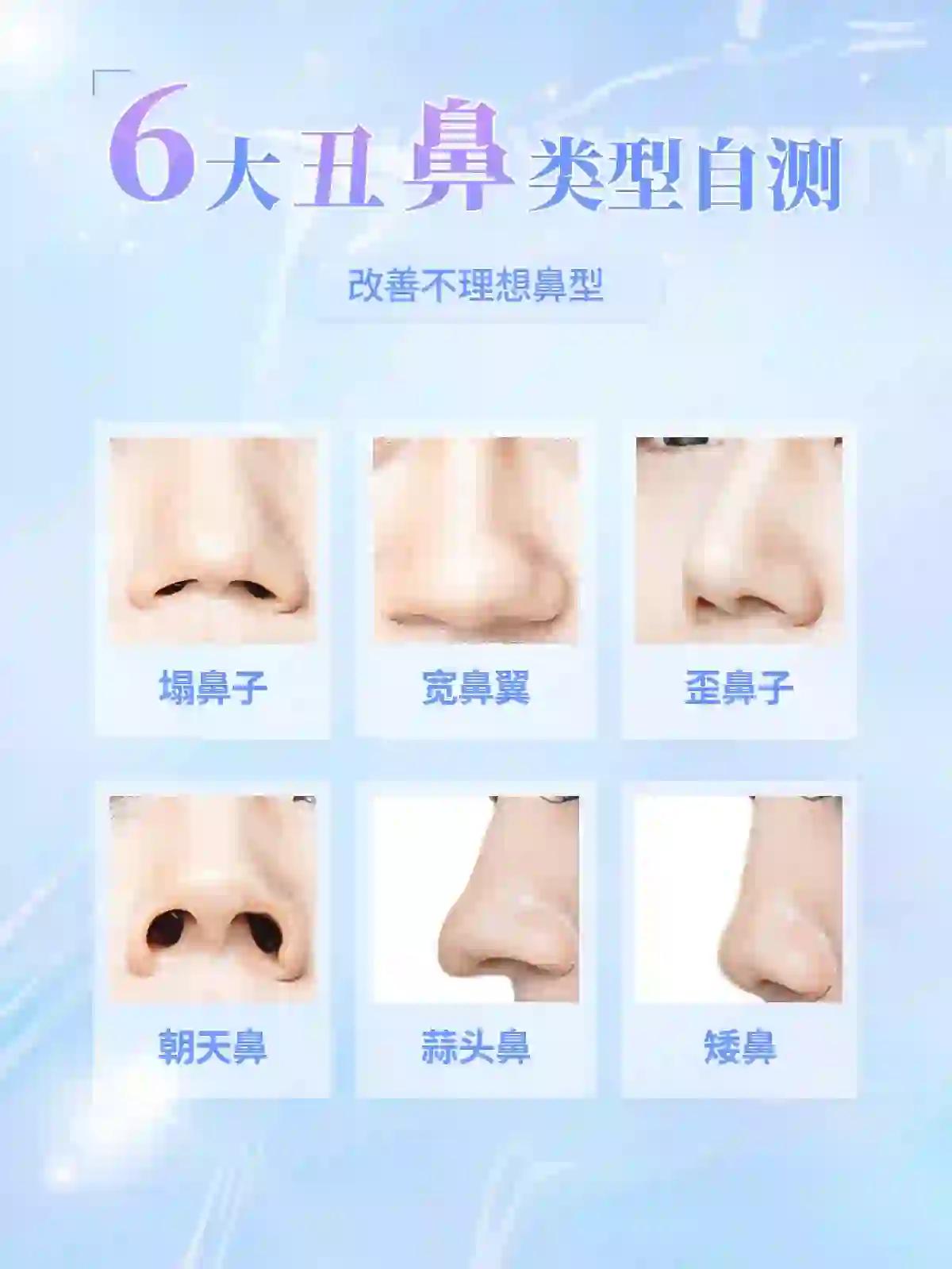 鼻子被称为是五官之王当然一个难看的鼻型也真是一鼻毁张脸