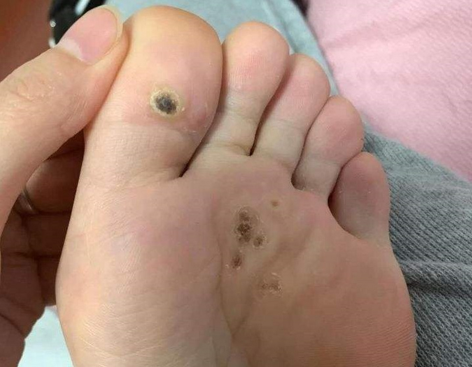 跖疣# #厦门皮肤科医院# 跖疣通常可以有一定的自愈性,但是自愈的