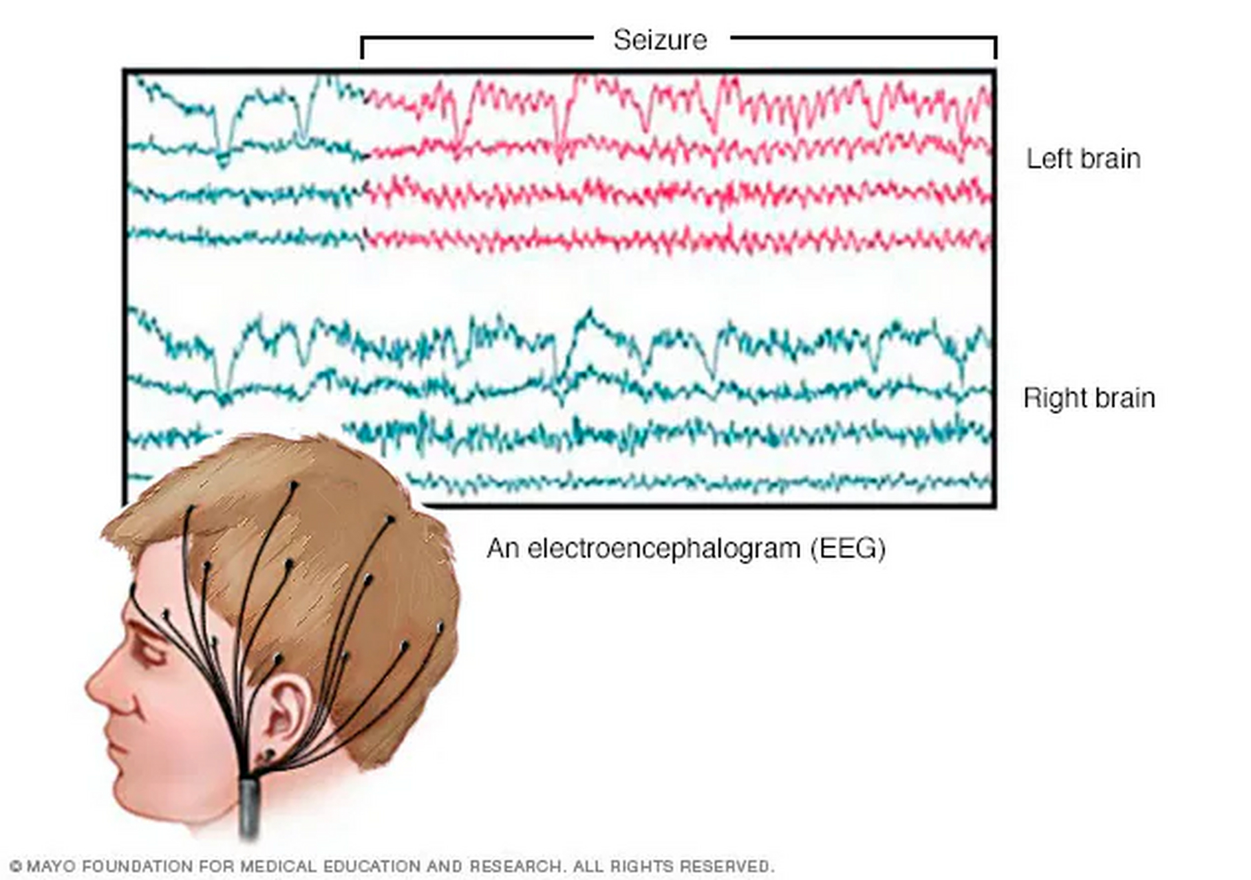 脑电图(eeg)是一种用于记录脑部电活动的非侵入性技术.