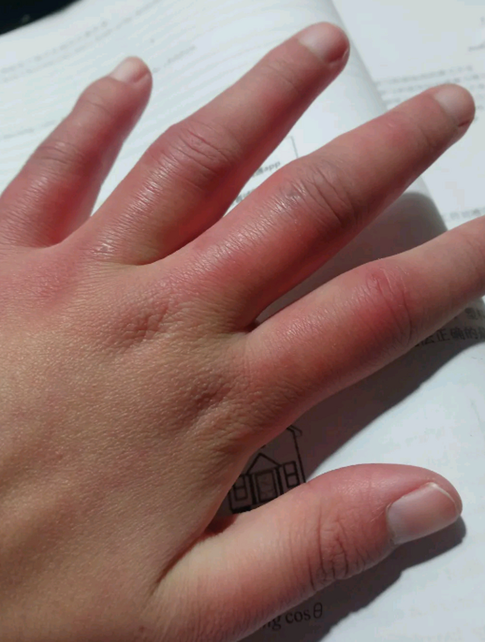 为什么我的手每年起冻疮?太难受了,又痒又疼