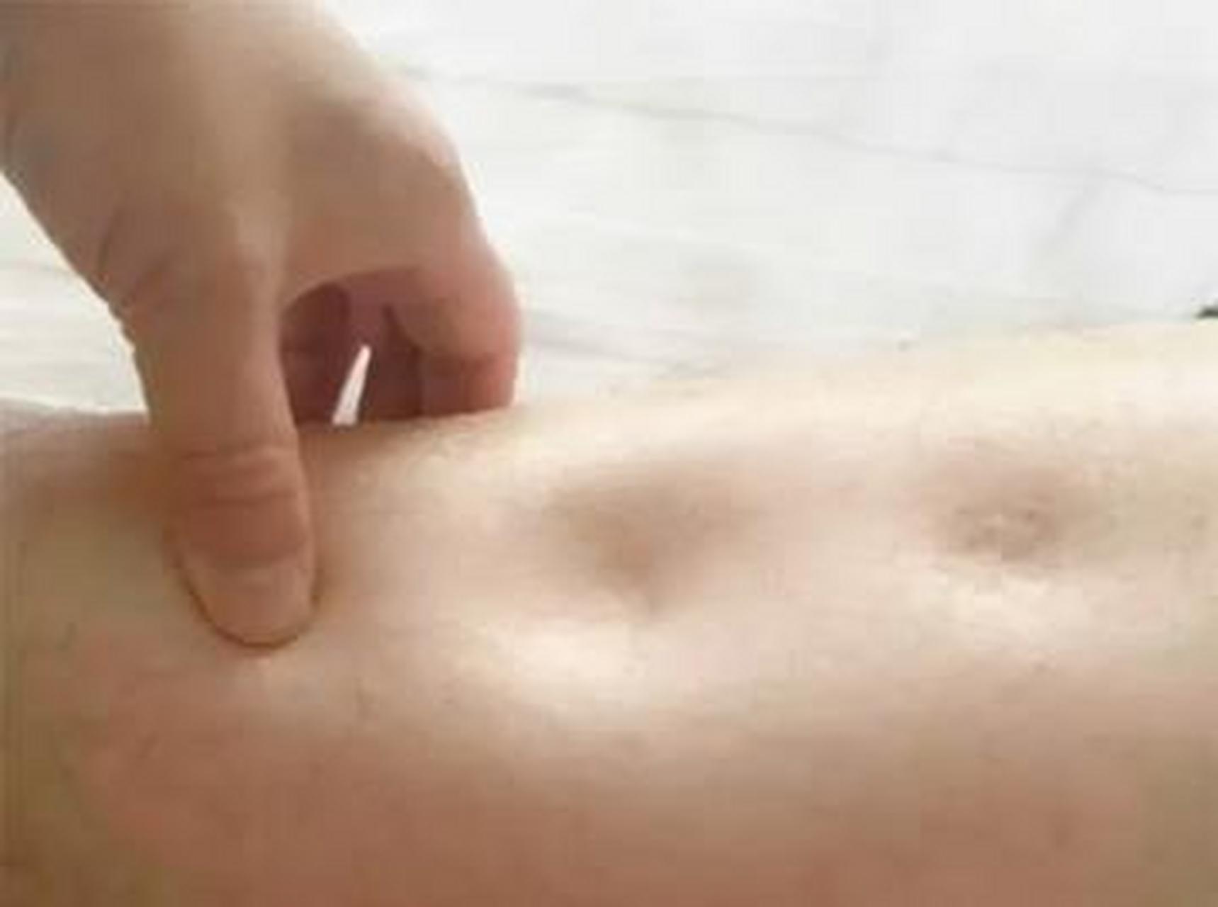 小腿水肿 一摁一个坑 要警惕肝病 张女士刚来找我的时候,小腿水肿,一