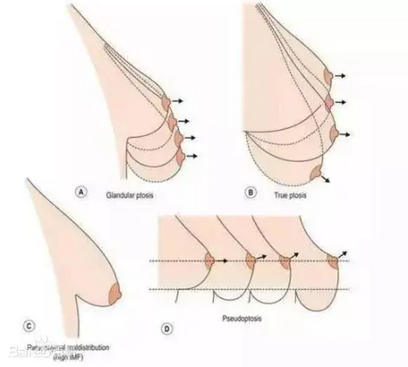 2,三角巾状:系整个乳房呈扁平状,像挂在胸壁上的三角巾,故得名.