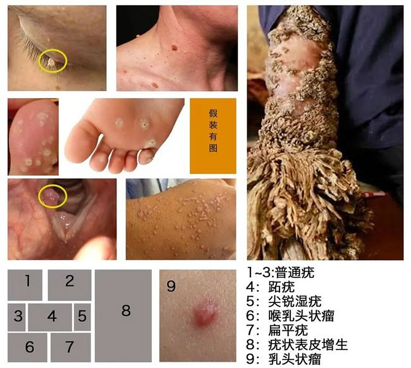 感染hpv后,皮肤这6处最容易出现异常  (1)寻常疣:米粒大小的丘疹,表面