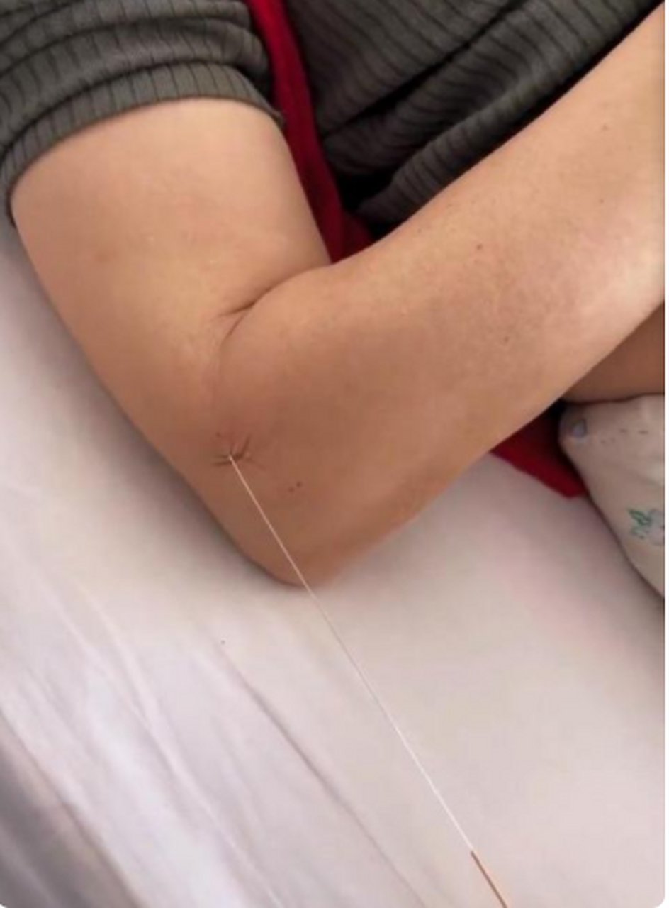 没扎过银针,也不知道疼不疼 !