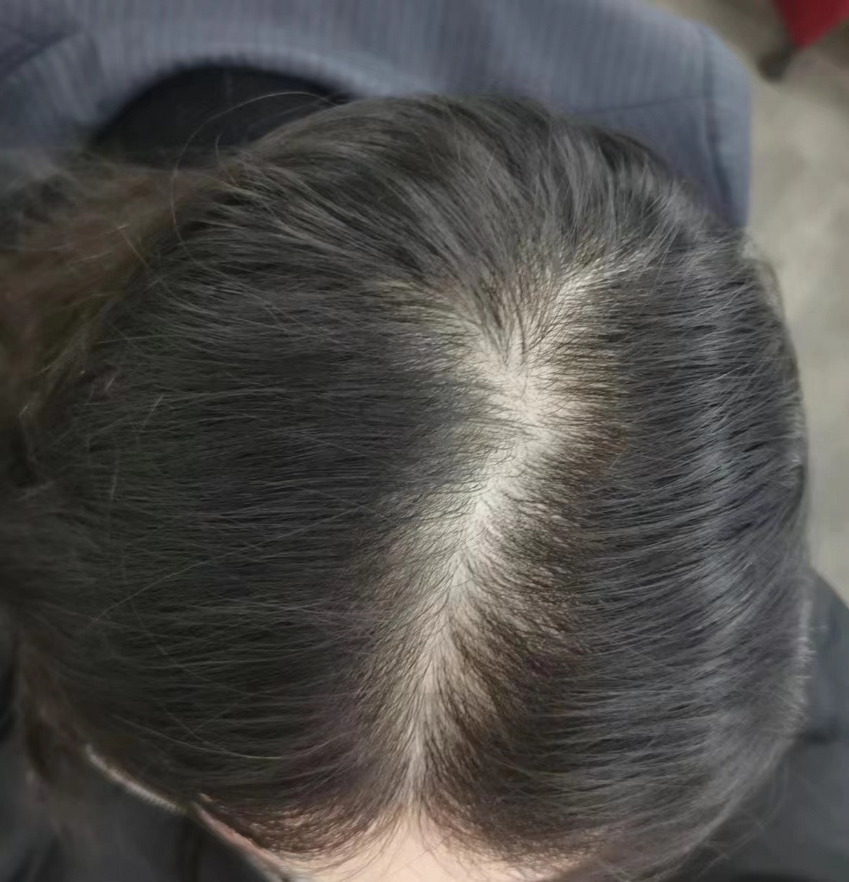 头发细软出油发缝宽?过来人的经验,只要毛囊护理得当,头发就能长出来!