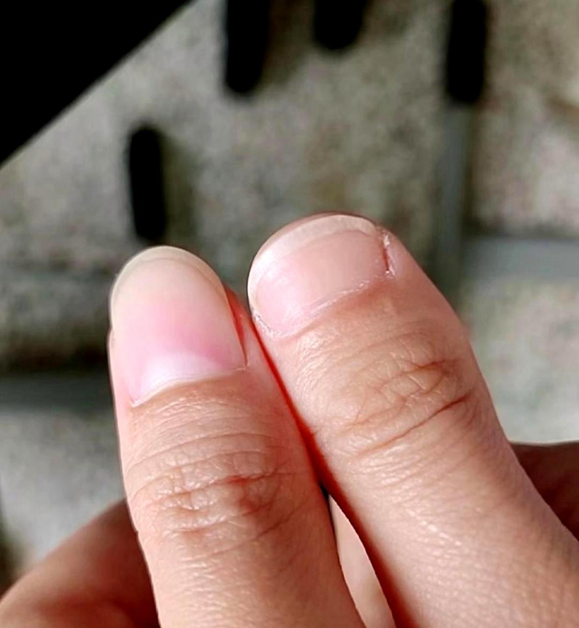 我很困惑,为什么我的两个手指甲的形状差异如此之大?