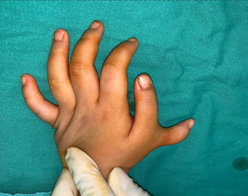 赘生指长什么样子图片患多指症宝宝图儿童手畸形四岁孩子手指正常图片