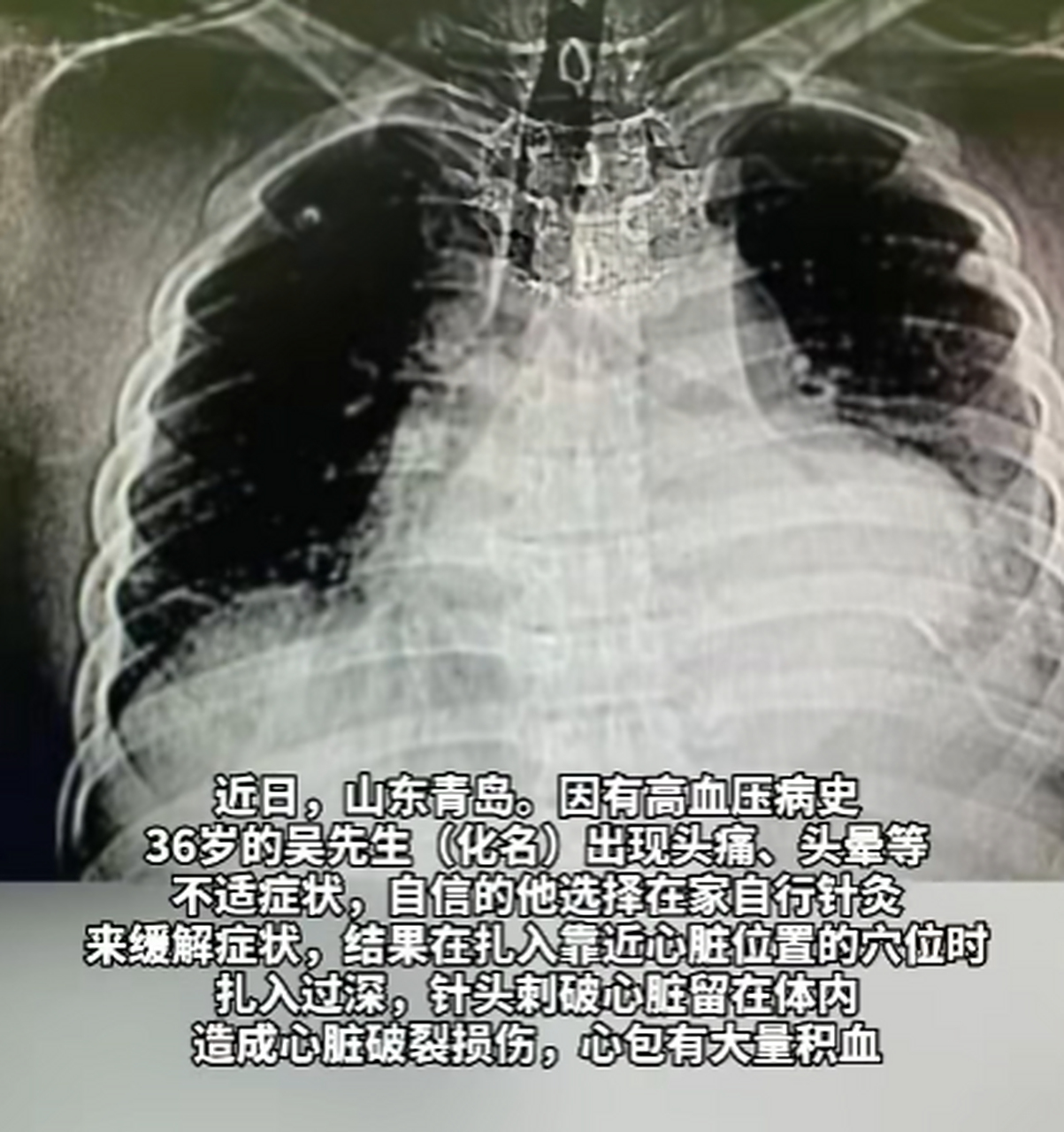 36岁男子头疼,自己在家针灸扎破心脏进了icu,网友:真"扎心"