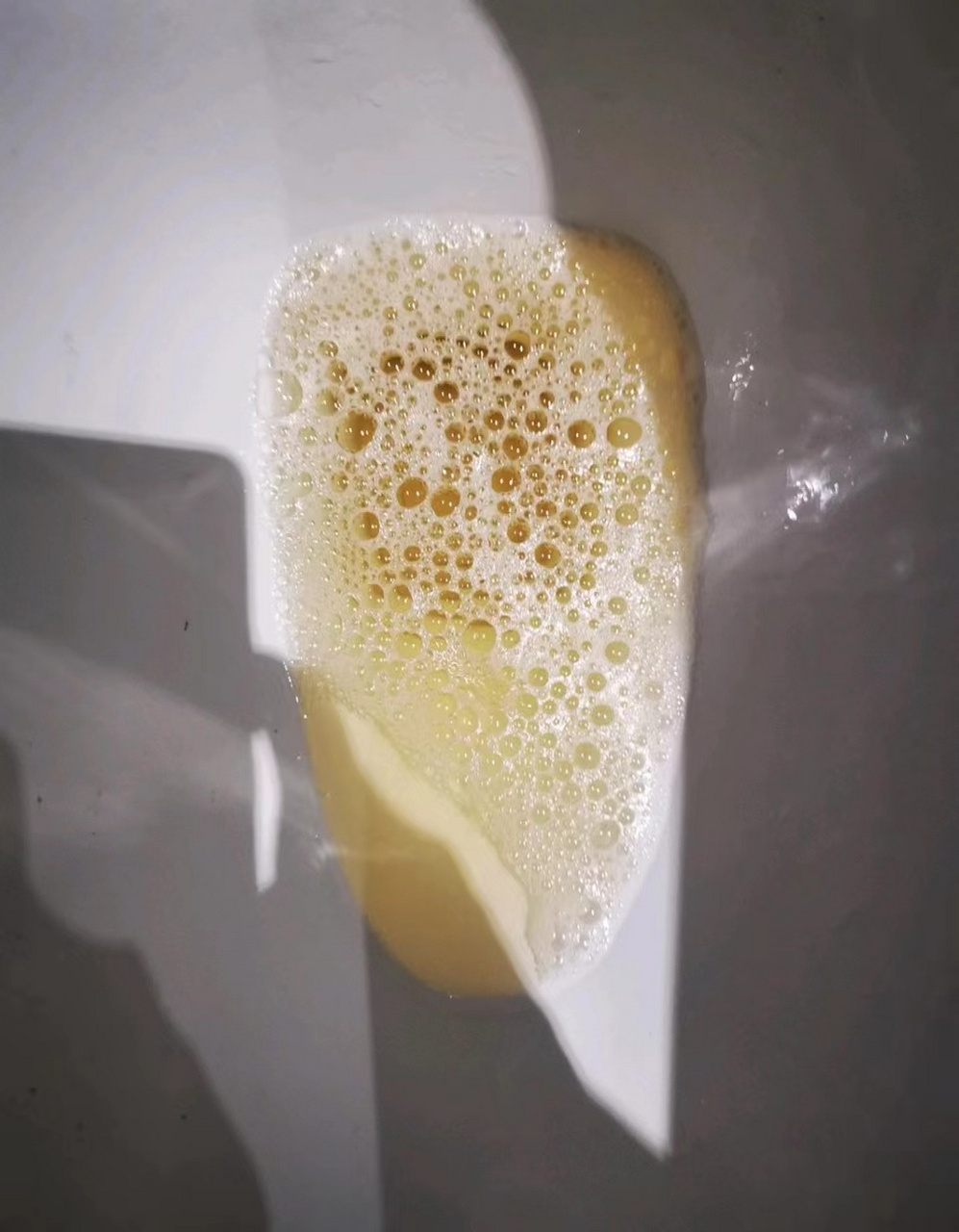 肾友都知道蛋白尿是肾脏病最典型的症状,那尿里有泡沫会是蛋白尿吗?