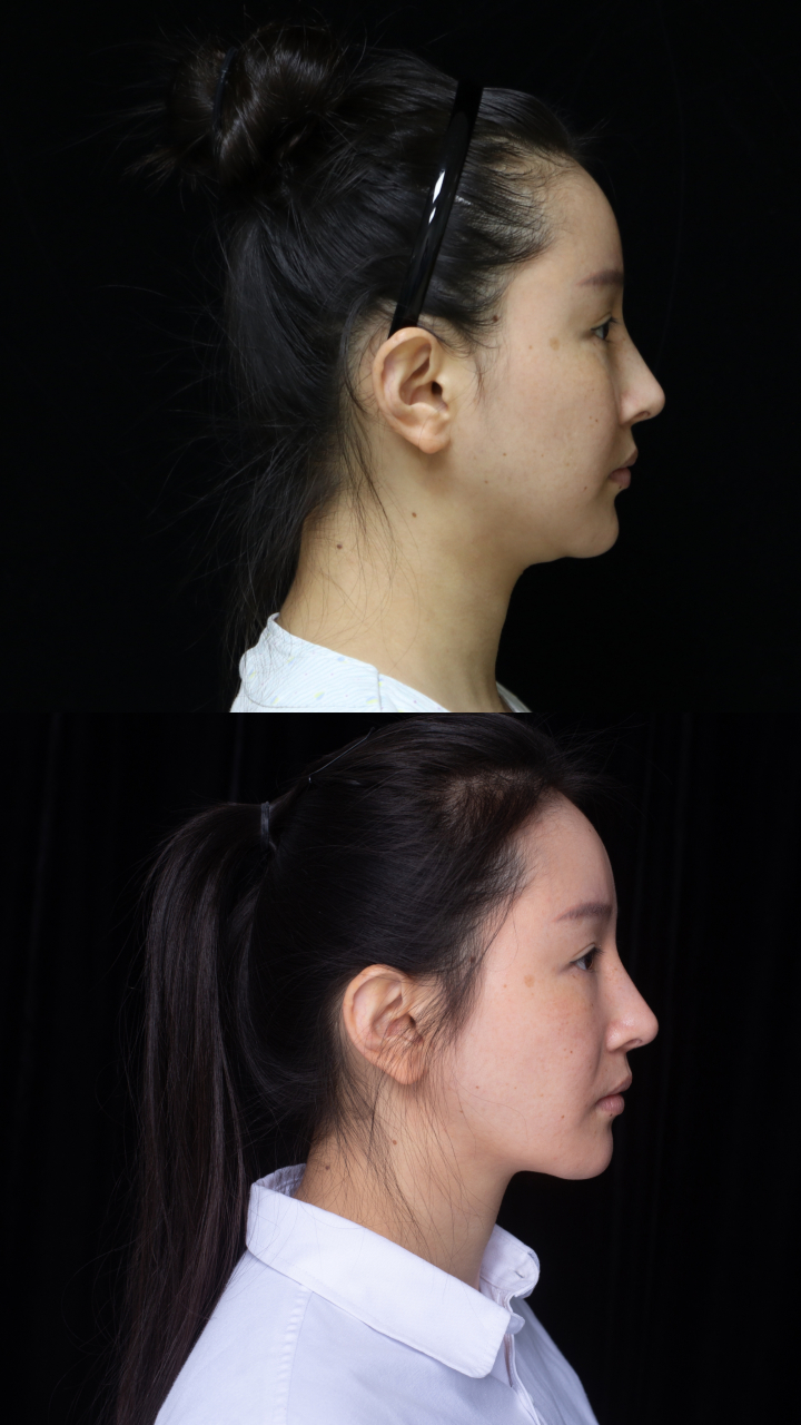 三维少女线面吸术后三个月对比 术前双下巴严重,下颌线也不清晰 和