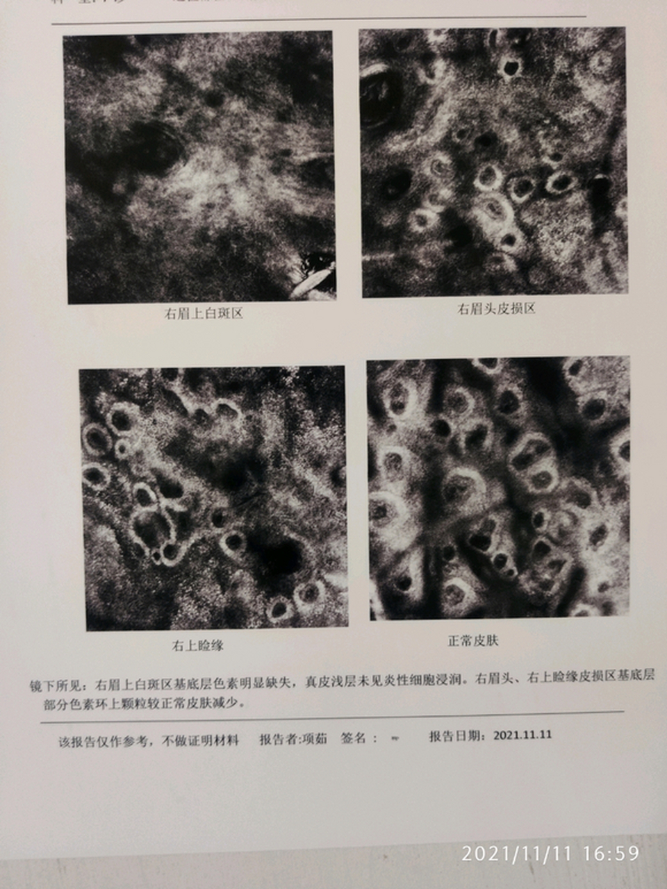 晕痣de治疗过程 1#晕痣# #健康经验笔记# #疾病治疗经验#   10.