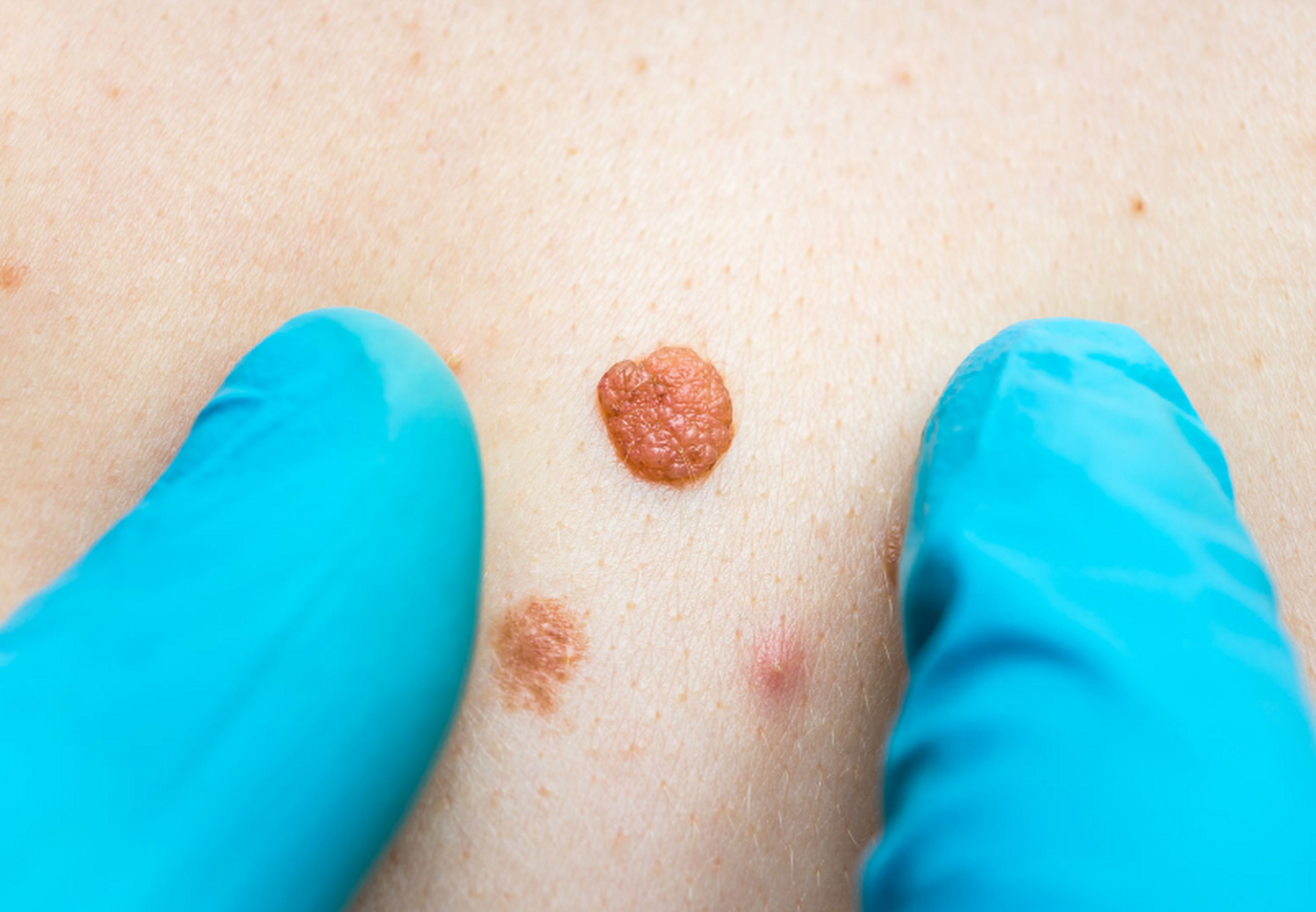 男性长了尖锐湿疣后,有哪些表现  男性一旦得了尖锐湿疣,体验自然也不