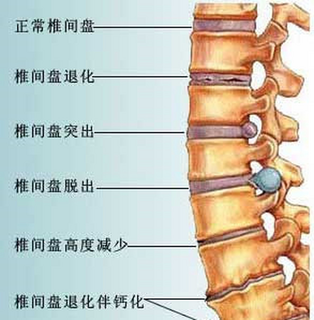 一张图搞懂腰间盘突出 一张图读懂#腰间盘突出# #腰椎间盘