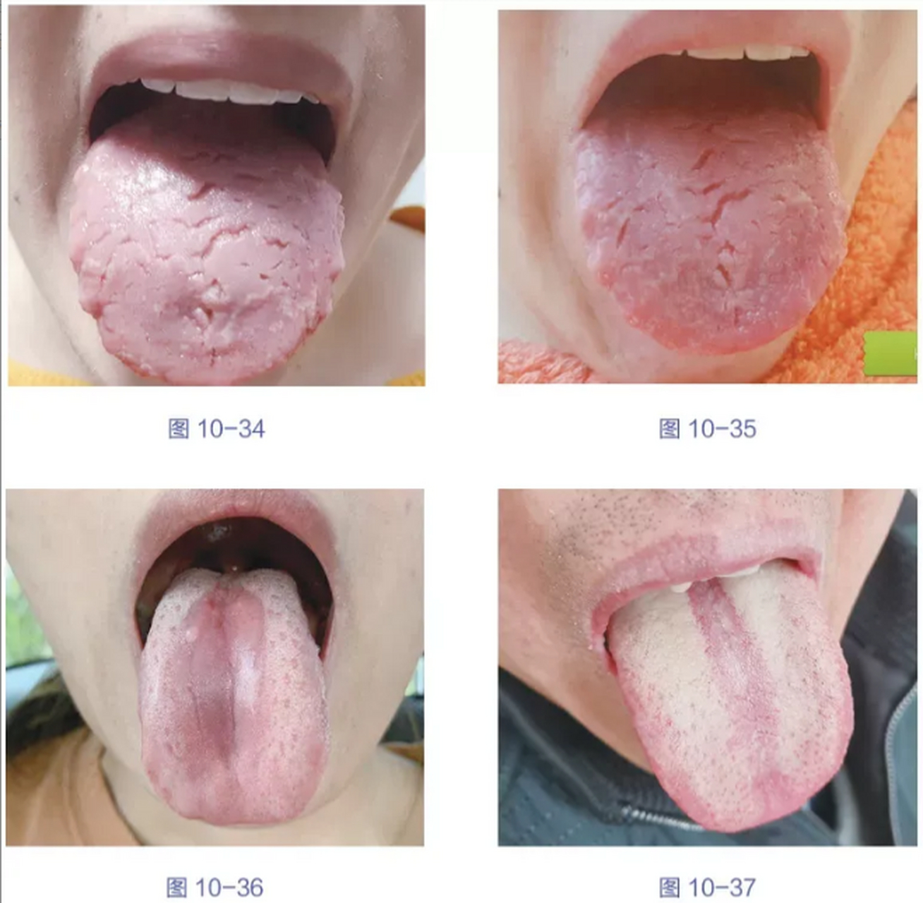 舌中的裂纹,对应的是脾胃区,不要轻视.