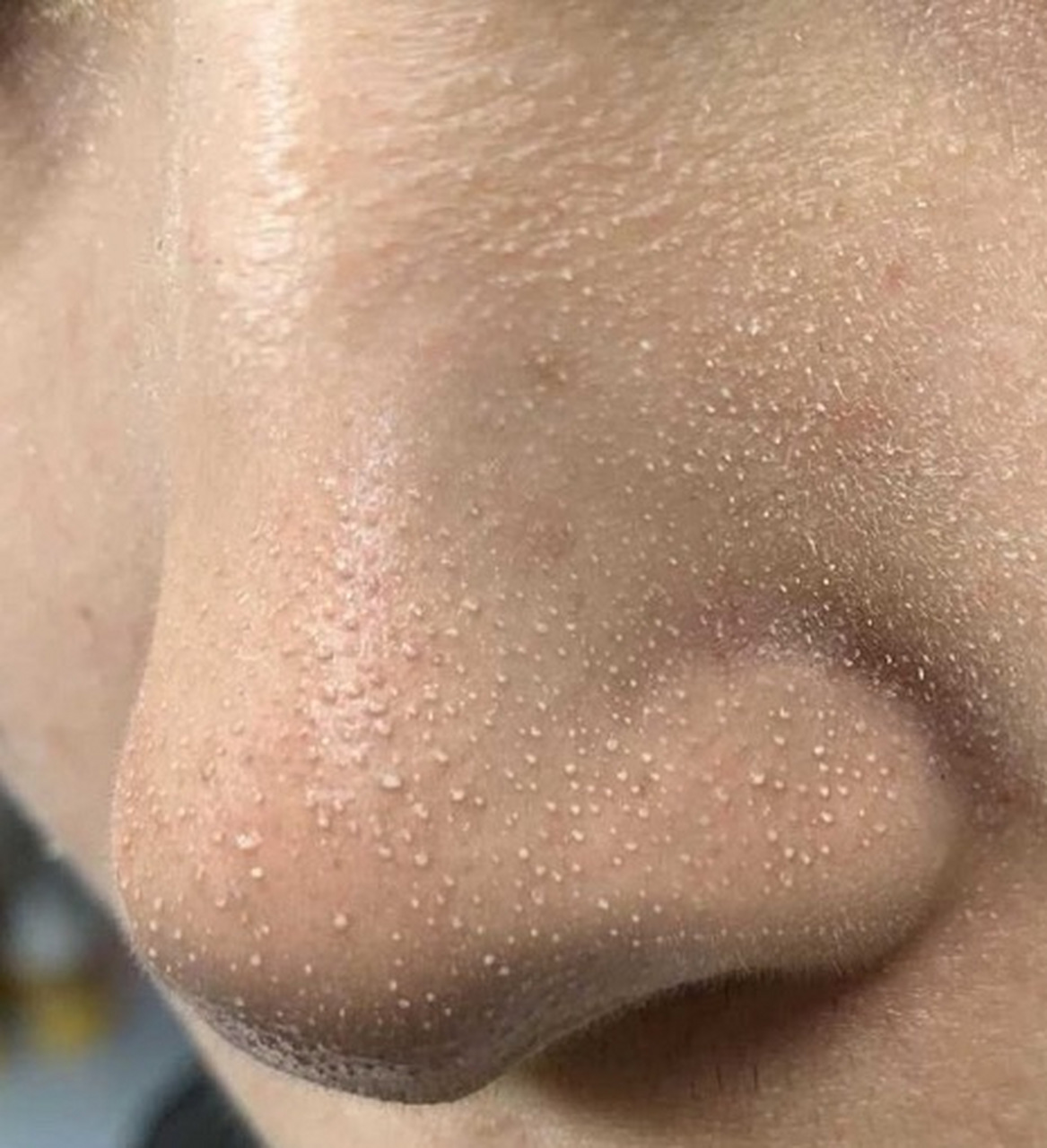 黑头毛孔粗大做什么医美项目?