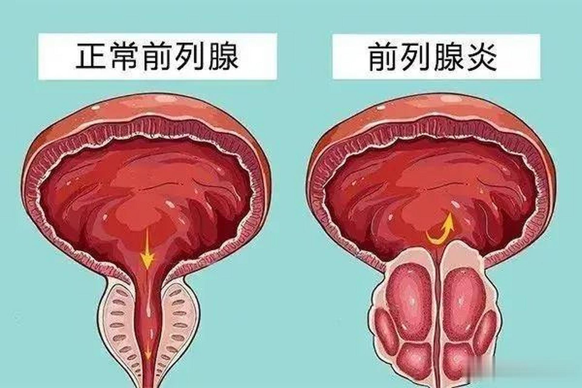 慢性前列腺炎,老王跟你坐下来好好谈谈慢性前列腺炎,被称为不死的