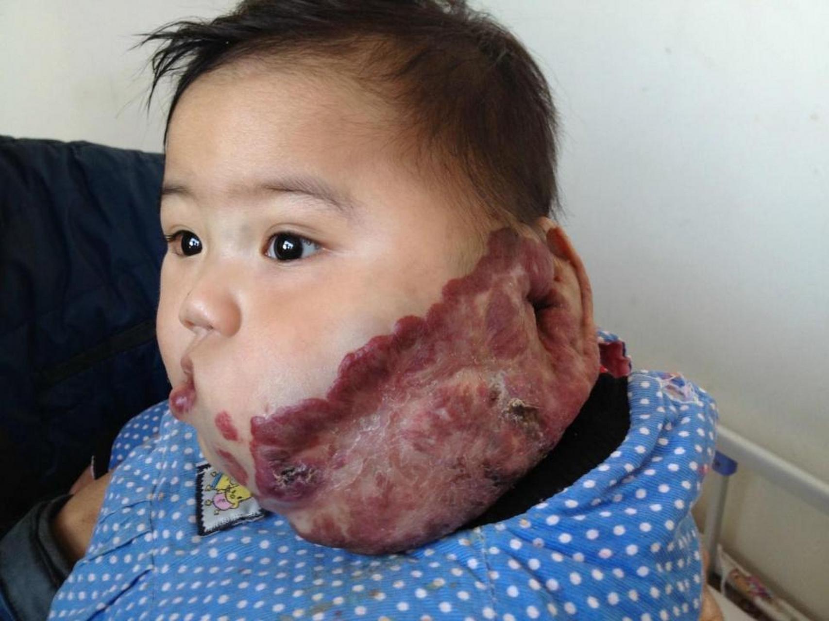 高风险血管瘤包括眼周,口周,鼻周,咽喉部,会阴部等处的血管瘤,具体如