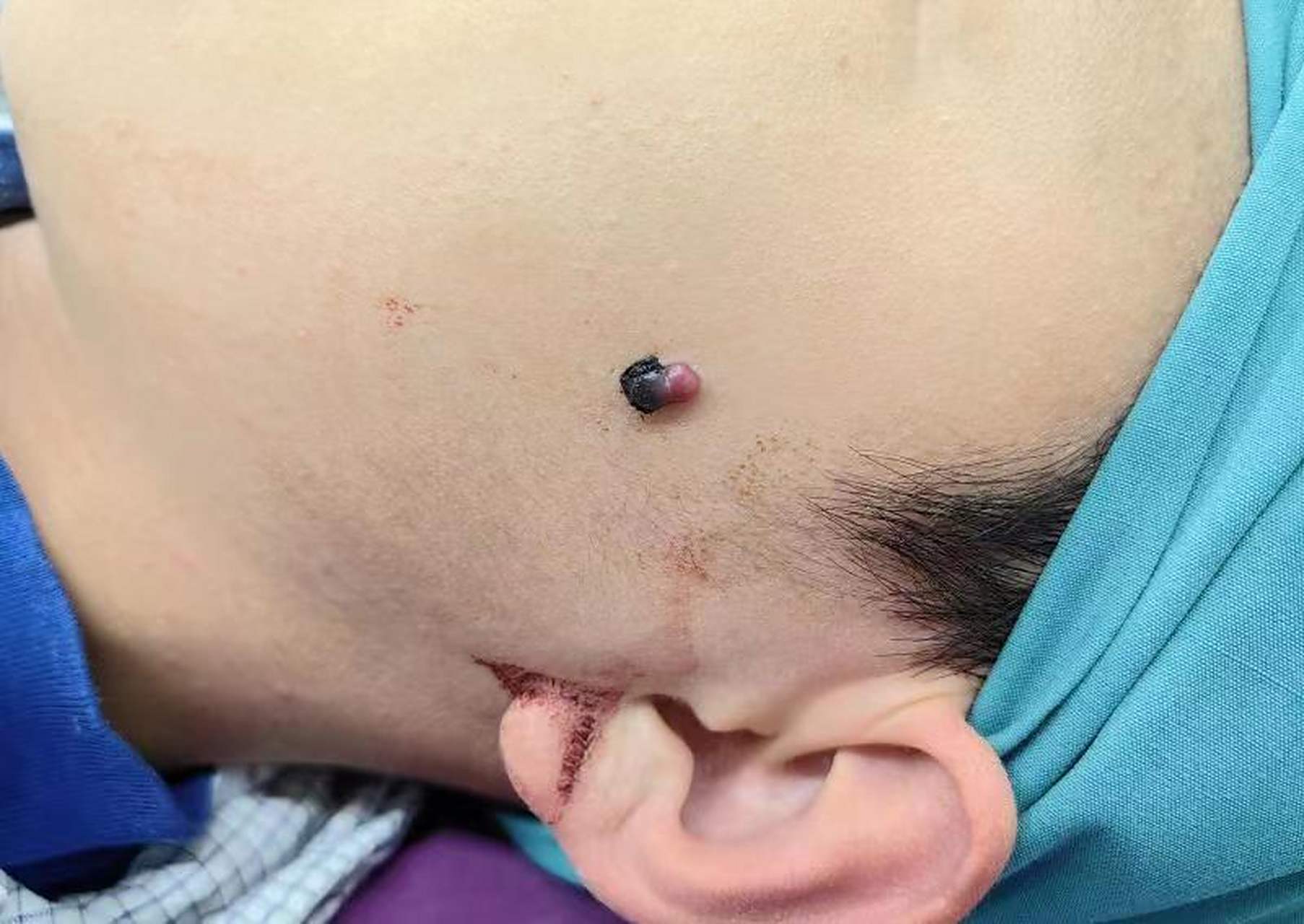 脓性肉芽肿,手术切除后美容缝合#化脓性肉芽肿