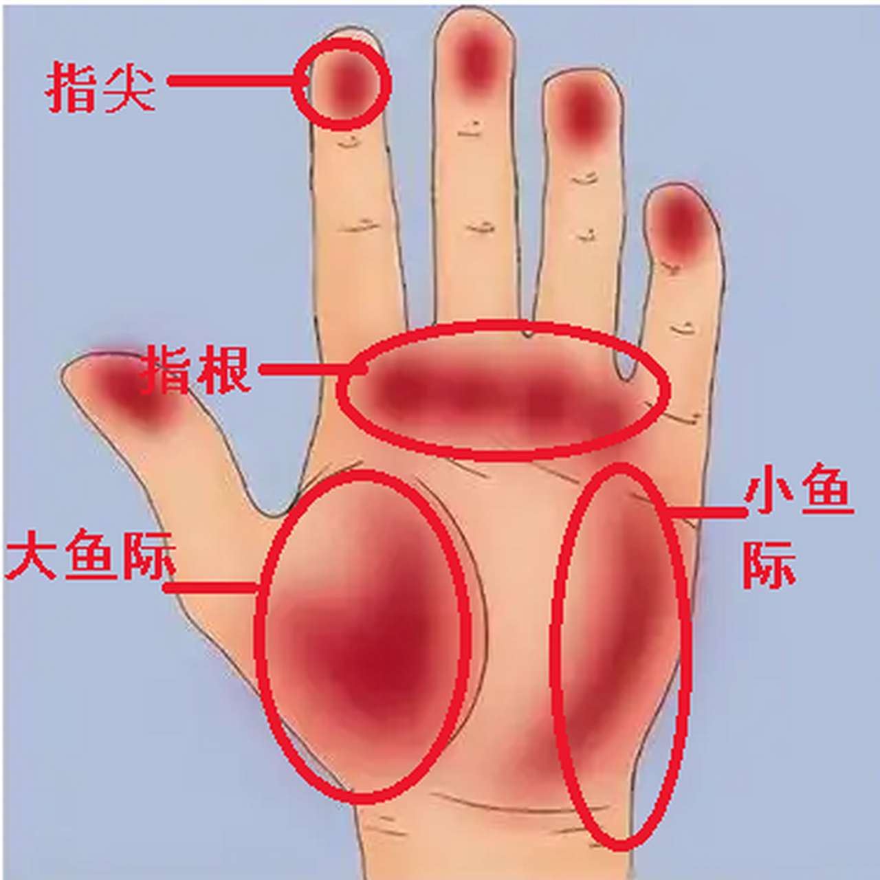 有乙肝肝硬化的手掌是和正常人不一样的,你知道吗?