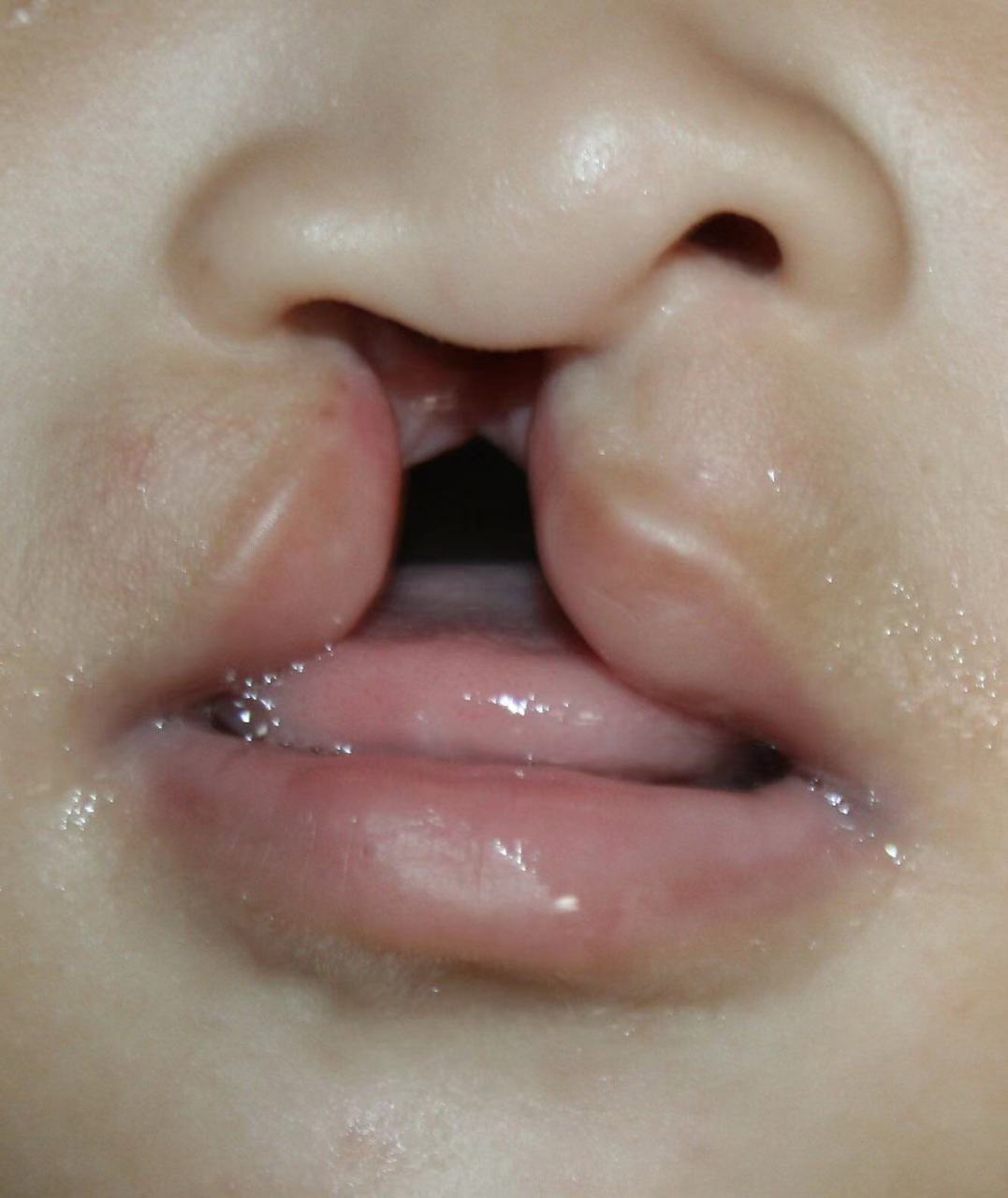 如果一个家族中有人患有兔唇,那么下一代患兔唇的风险会增加.