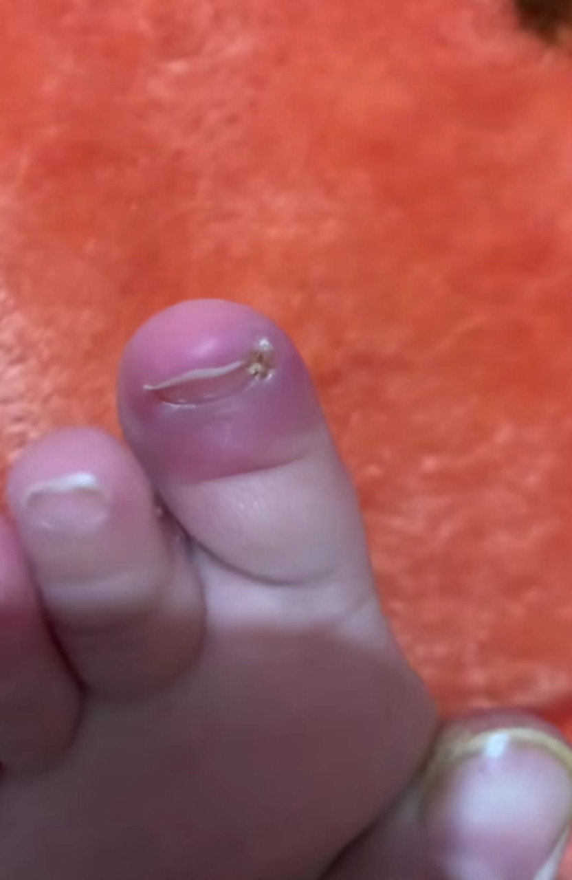 宝宝的脚趾甲从出生起就翻起来,里面长了肉. 我不敢碰它们.