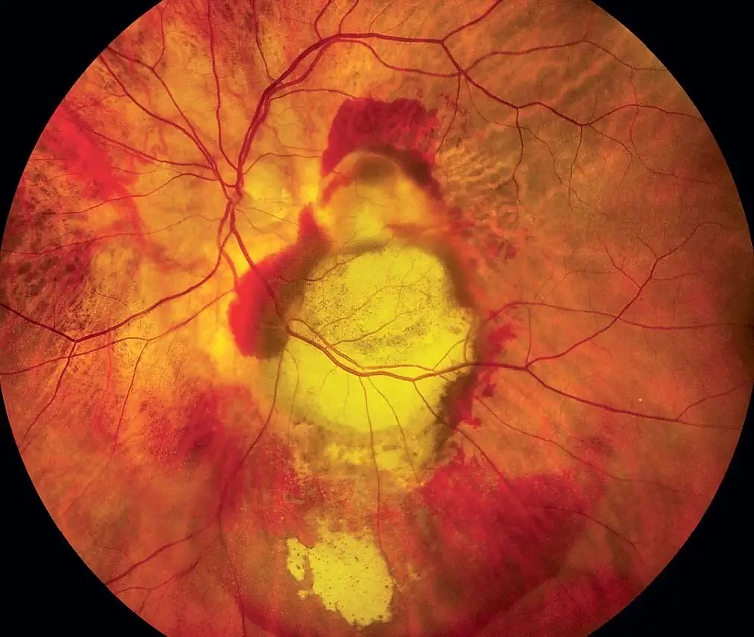 因此,辨证施治是中医治疗眼底出血的根本方法