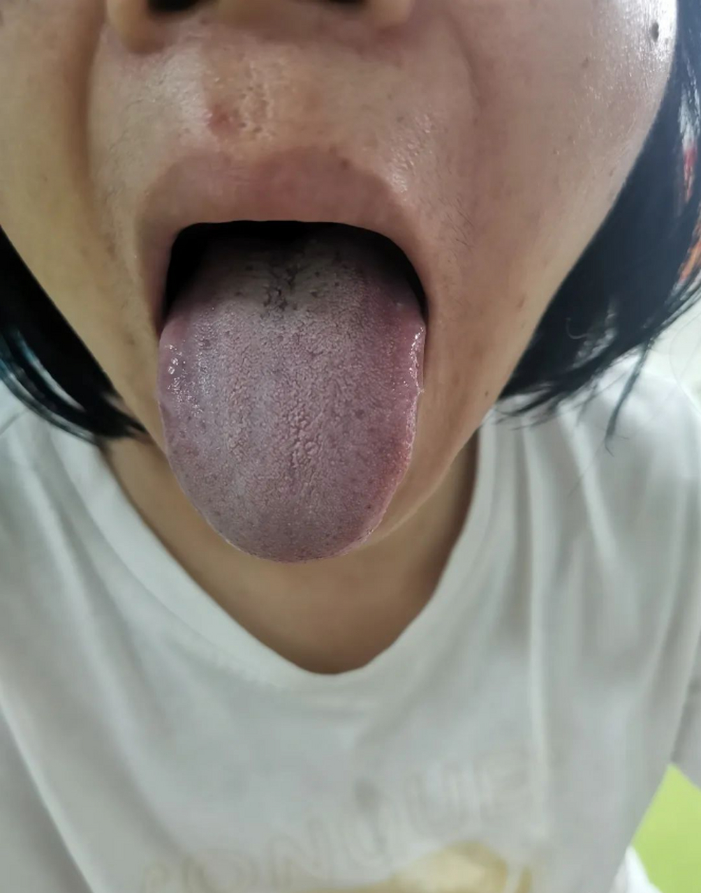 张医生教你看舌头,观舌知健康 胸闷气短,肠胃不适,脾气暴躁,血瘀