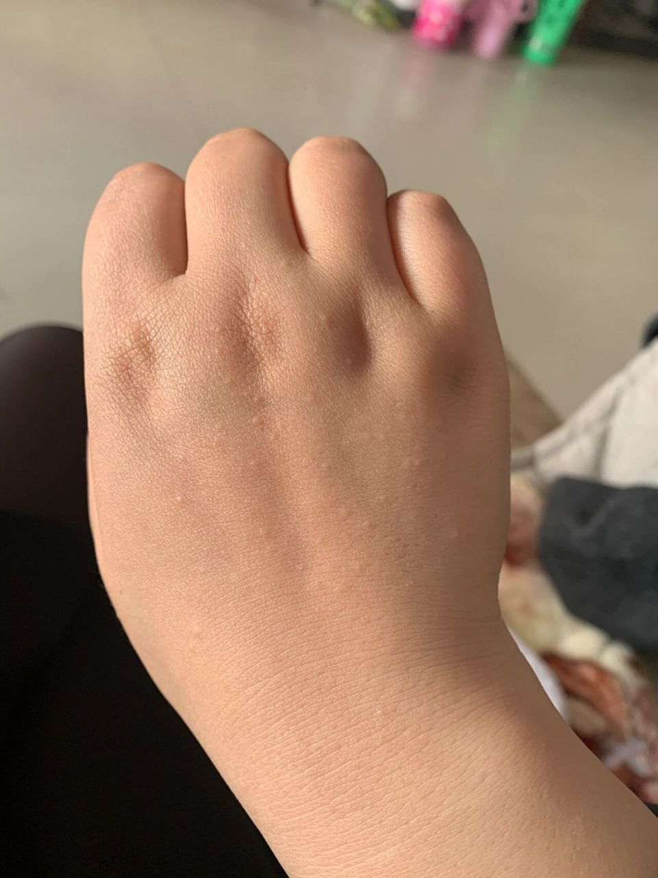 手背上起了好多疙瘩这是什么东西	两个手背都有,刚起的,不痛不痒,手腕