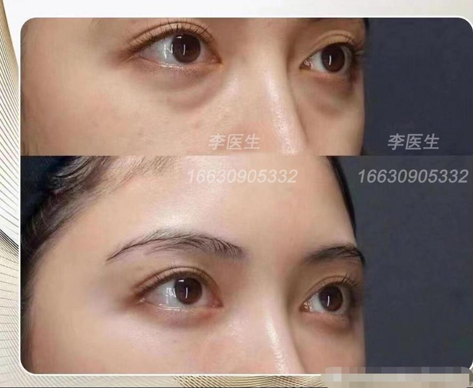 泪沟又被称为阴影型黑眼圈,它主要是下睑组织充盈度不够,加上衰老的