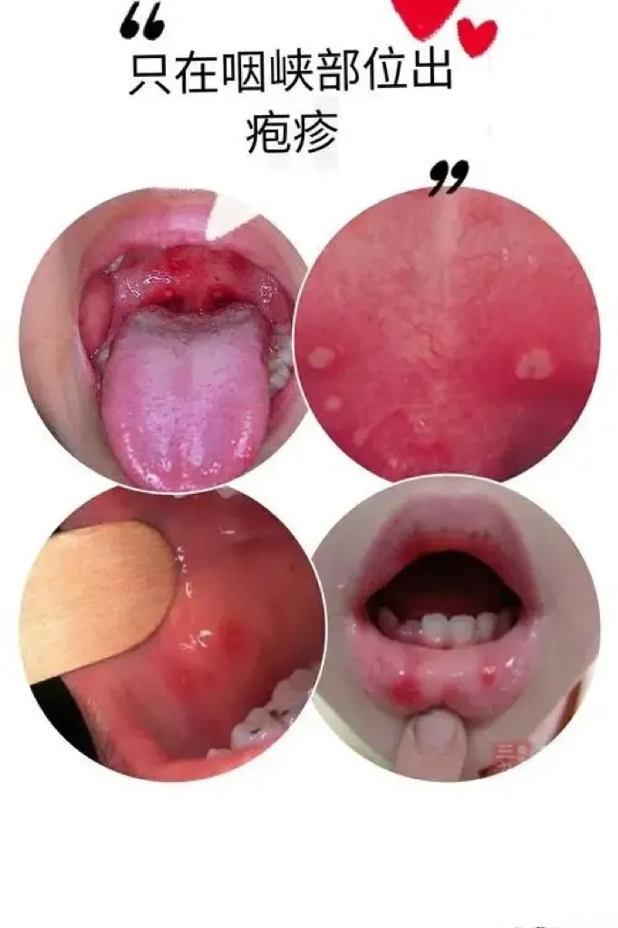 性咽峡炎的图片疱疹性咽颊炎疱疹性咽峡炎图片和症状图片疱疹性口腔炎