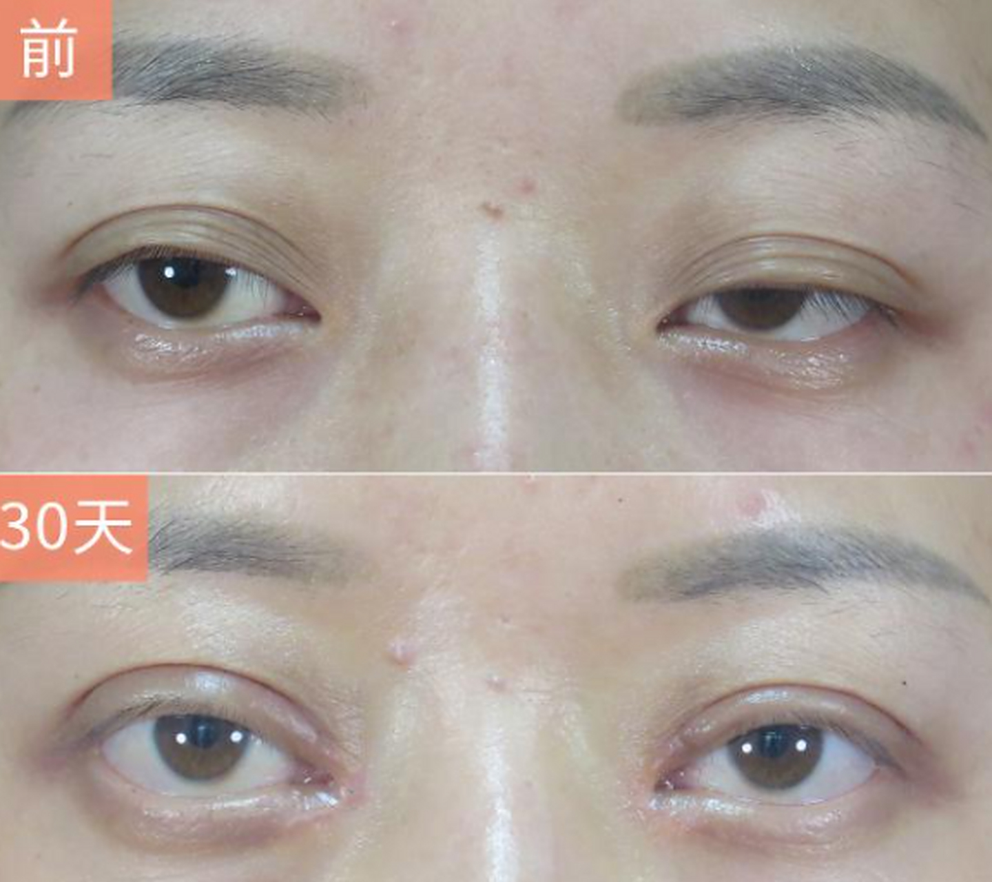 下图是为先天性上眼皮下垂很严重的姑娘,从小眼睛就睁不开,视野受到