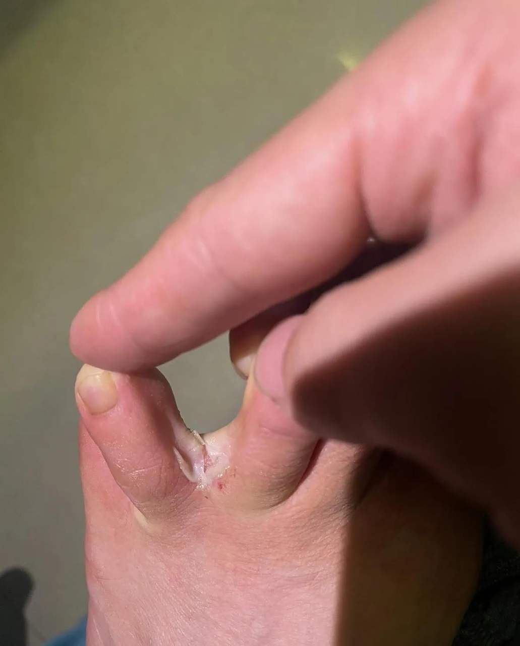 脚成这样了,特别的痒,不知道咋回事.