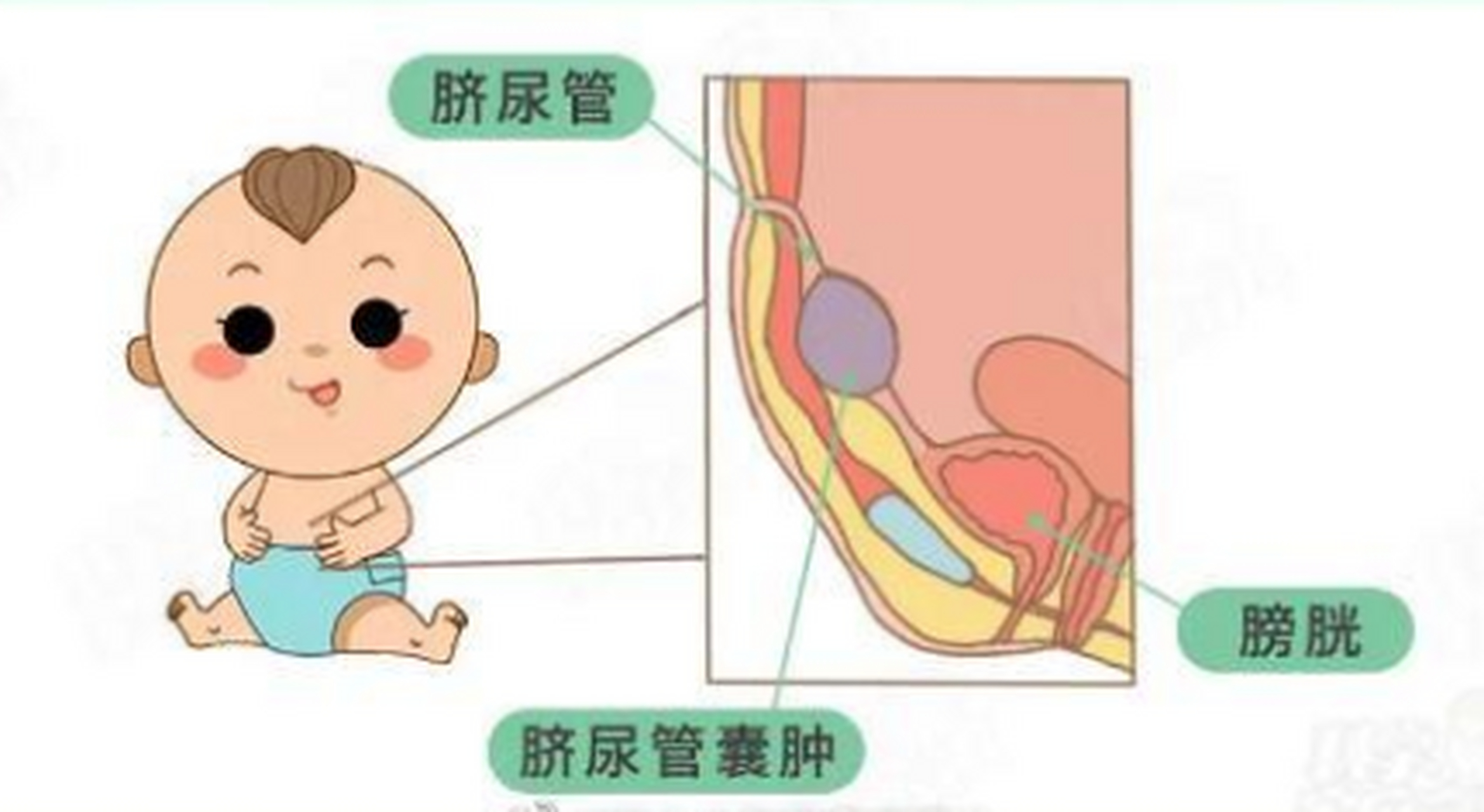 如果宝宝的脐尿管没有闭合好,上皮的分泌物或脱落细胞碎屑就会掉落到