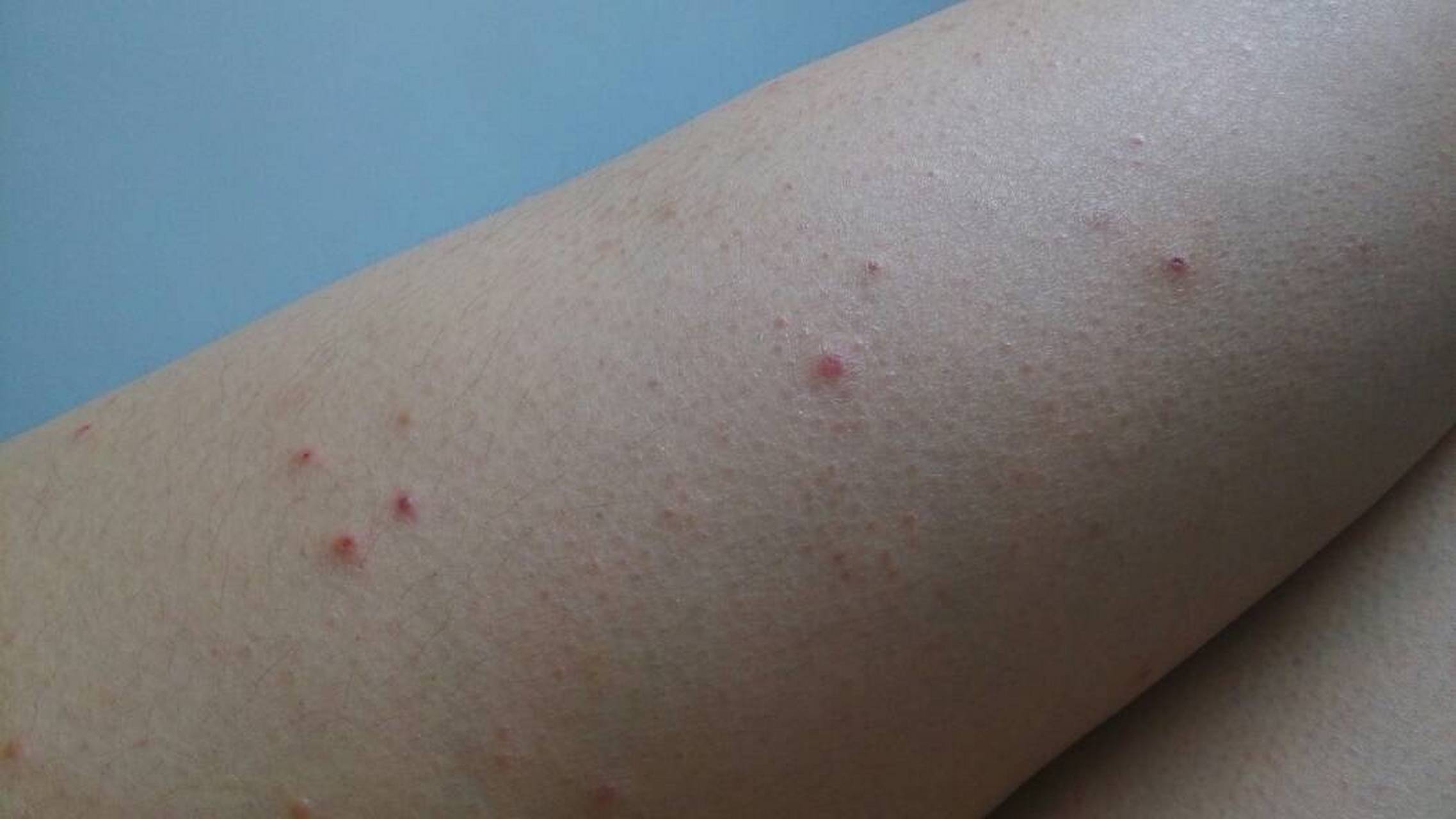 这种红点叫蜘蛛痣,用手按住中间红点,周围的血管就消失不见了,这