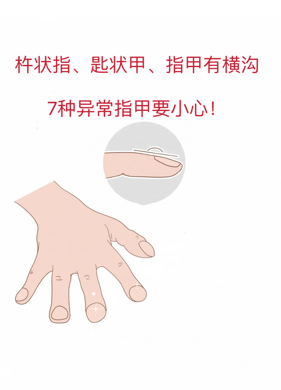 杵状指,匙状甲,指甲有横沟,7种异常指甲要小心!