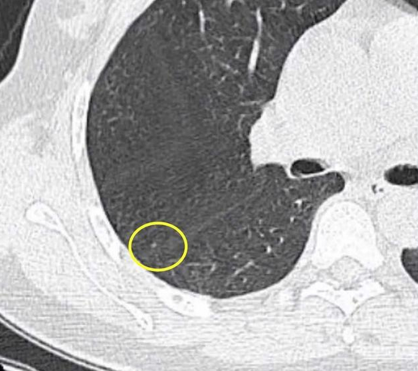 小于5毫米的肺结节要不要马上手术?