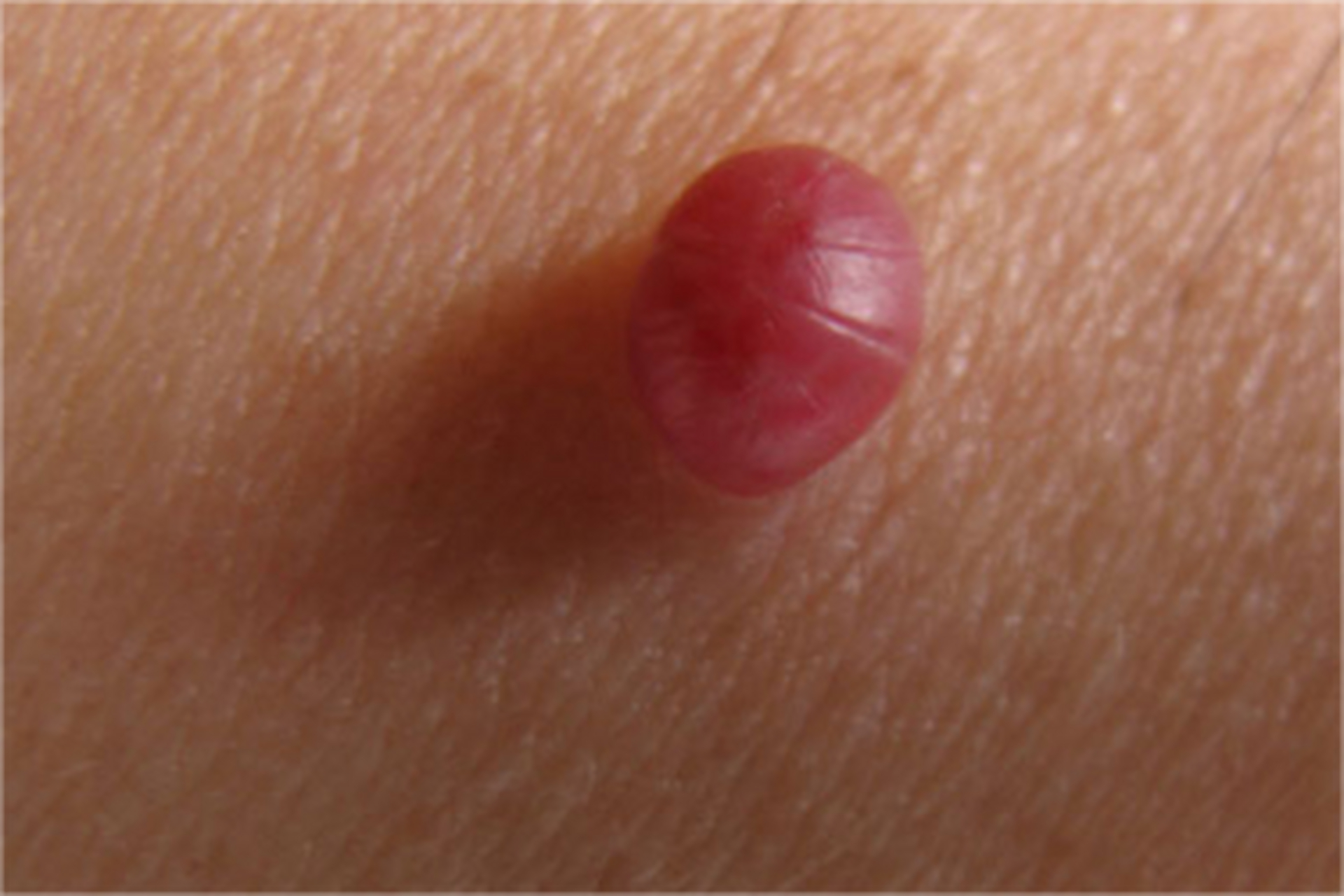 血管瘤怎么治才会消失啊  1,血管瘤只是皮肤表面 病