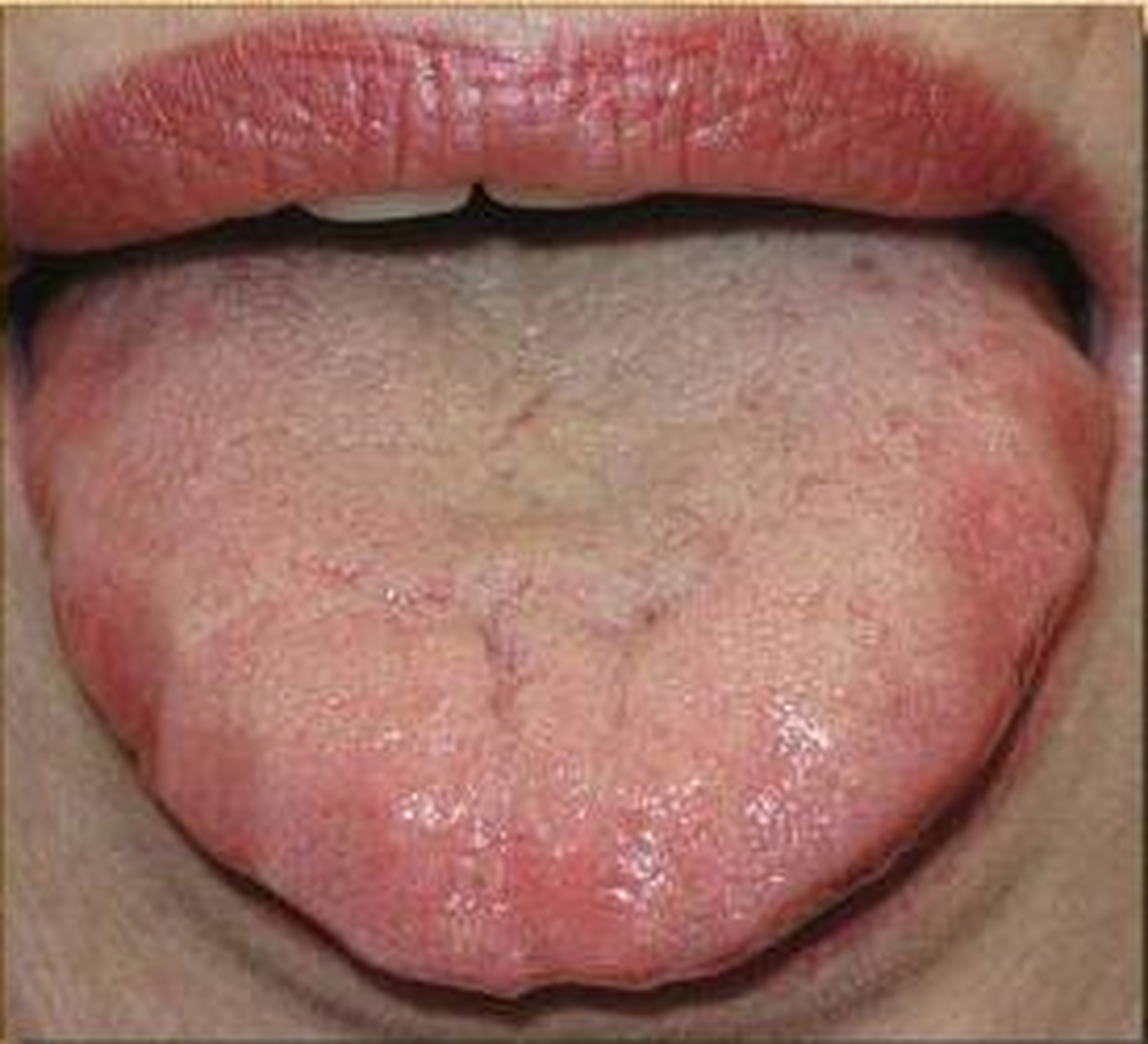 齿痕舌的4种情况  1,气虚齿痕舌 特点:舌头偏胖,偏肿,舌苔比较干净,当