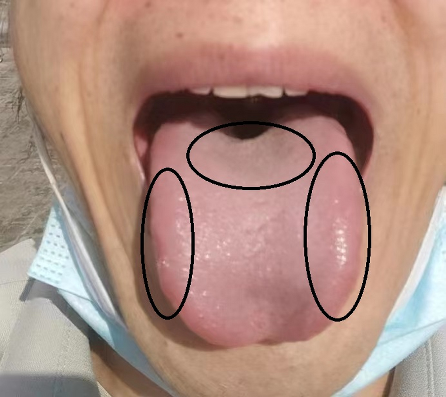 舌象来看,舌体胖大,有齿痕:气虚,体内湿气重. 中焦凹陷:脾胃虚弱.