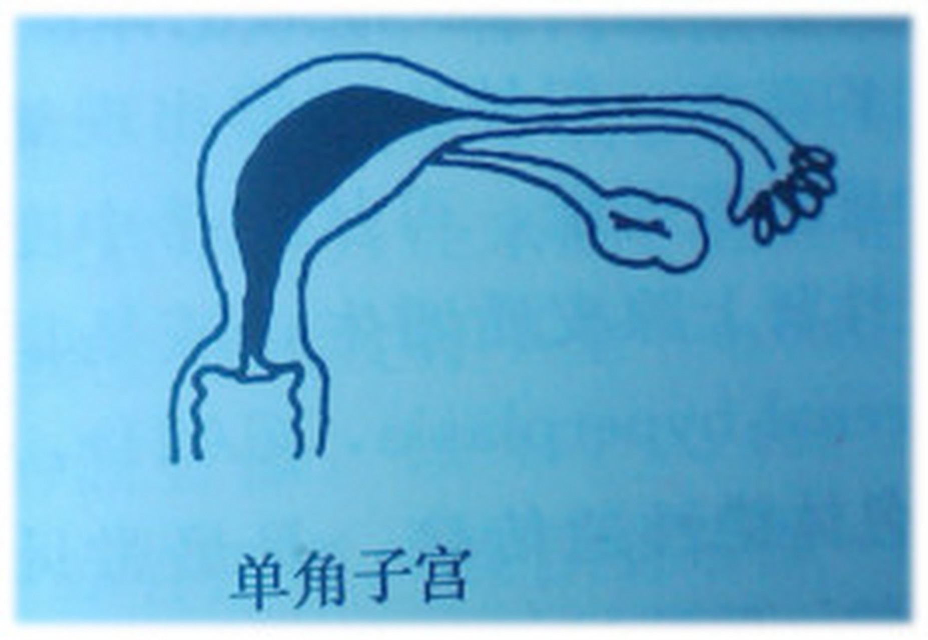 单角子宫怀孕图片