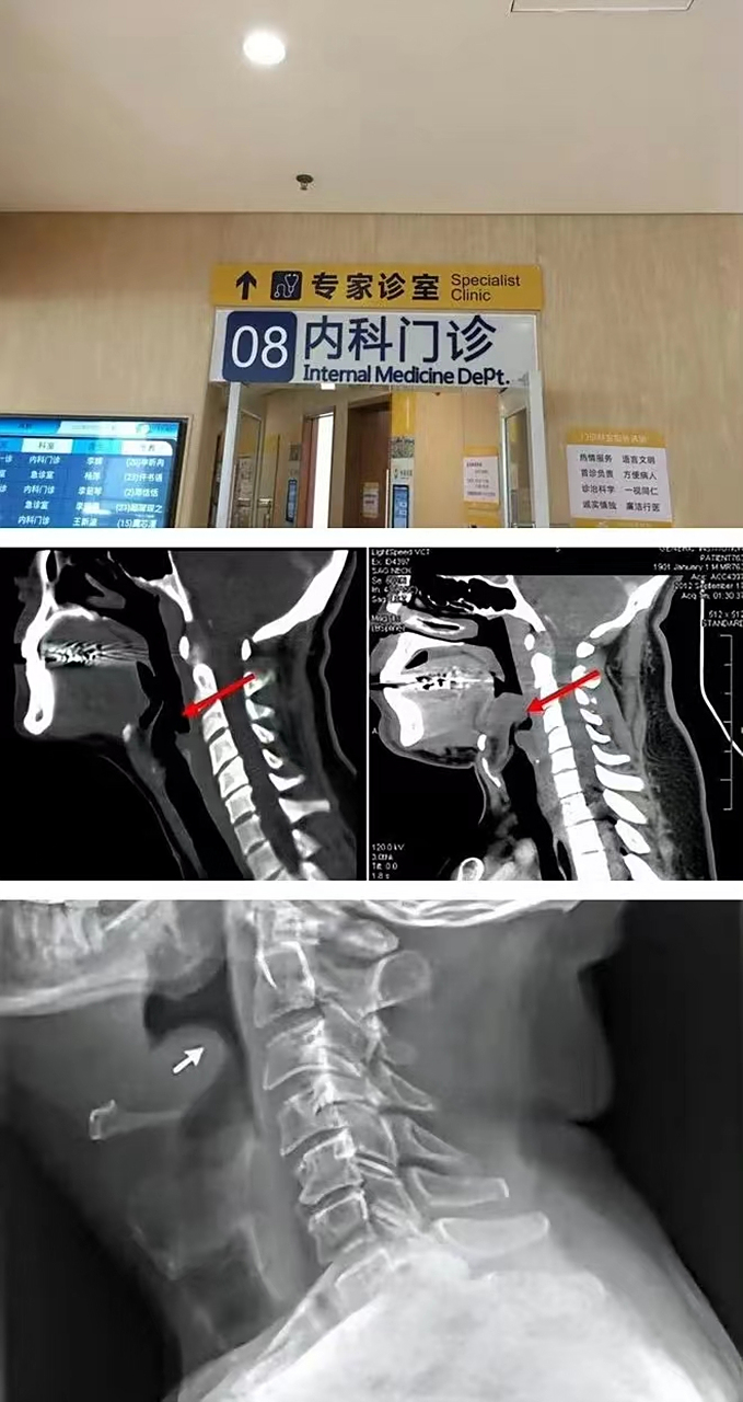 不是所有喉咙痛都是上火,注意急性会厌炎,喉科重症  一位网友分享,他