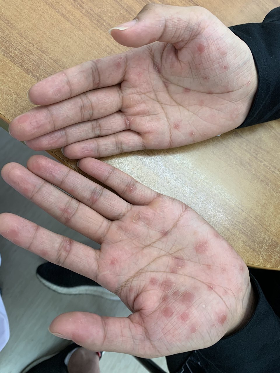 患者手部出现皮疹,按照湿疹进行治疗却未见成效,原来是梅毒疹在作祟