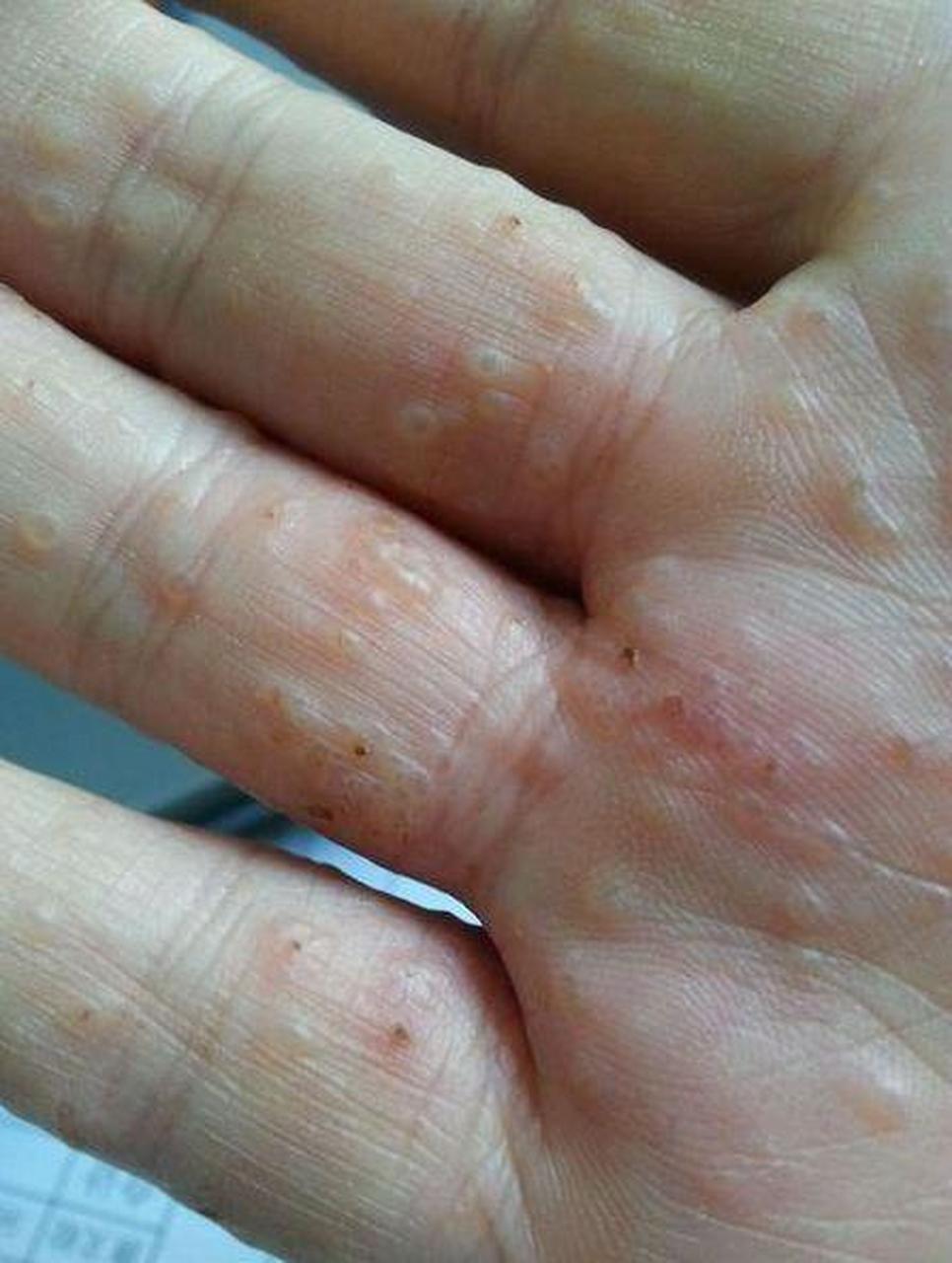 手掌心手指缝长透明小水泡还痒得受不了,咋回事?