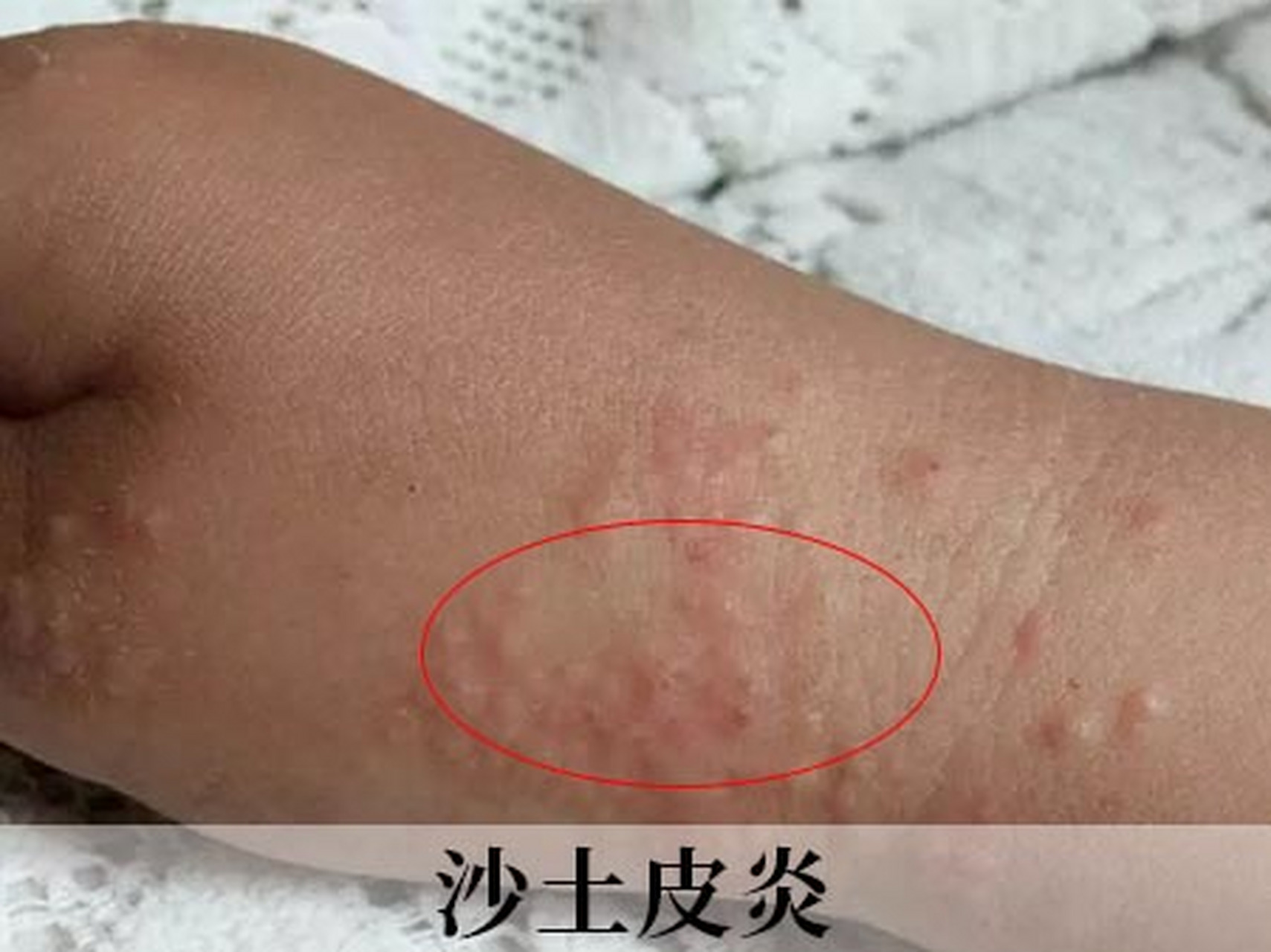 荨麻疹,手足口病,沙土皮炎傻傻分不清 鉴于我最近门诊中,前来看小